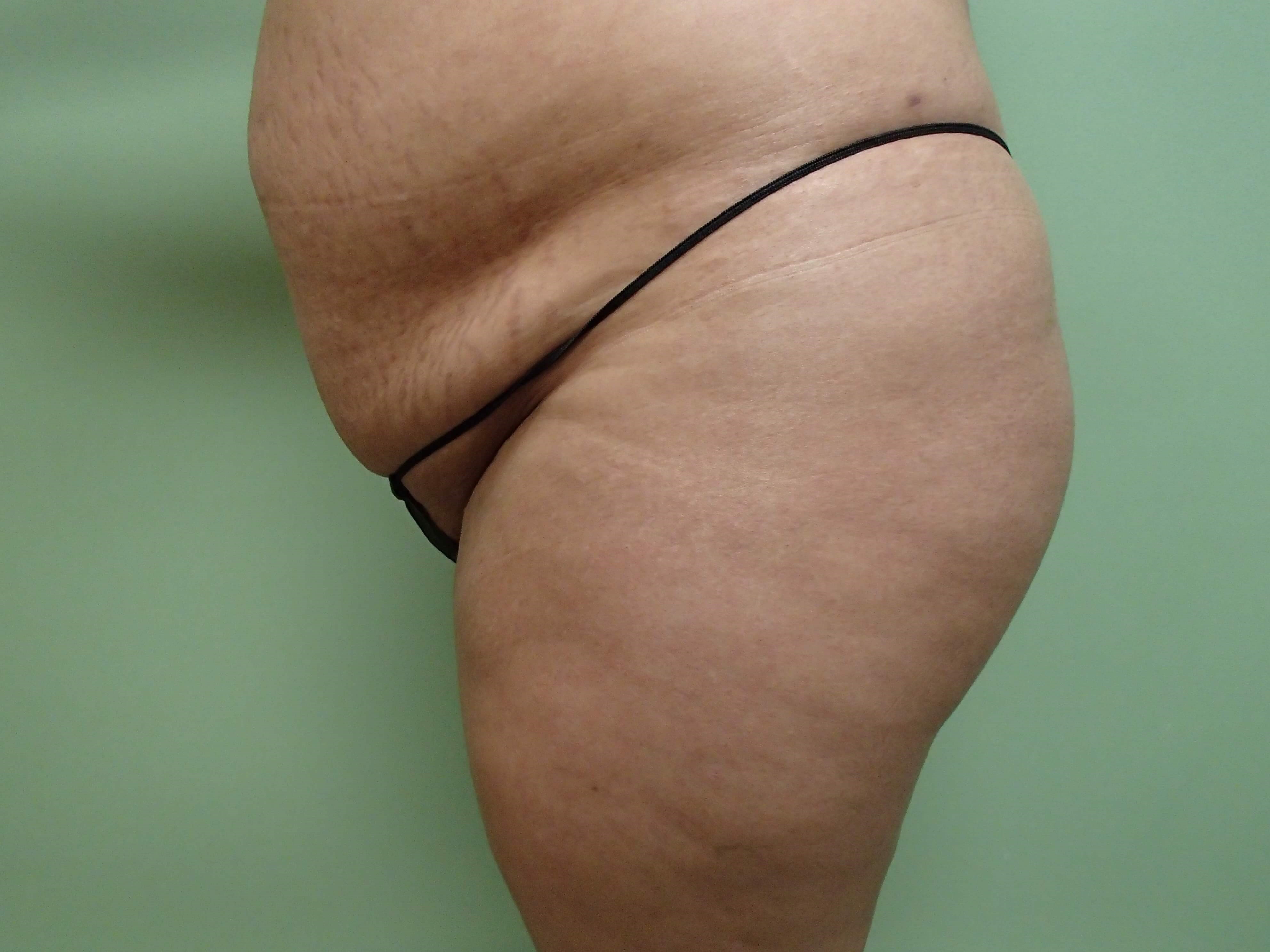 Brazilian Butt Lift (BBL) Before
