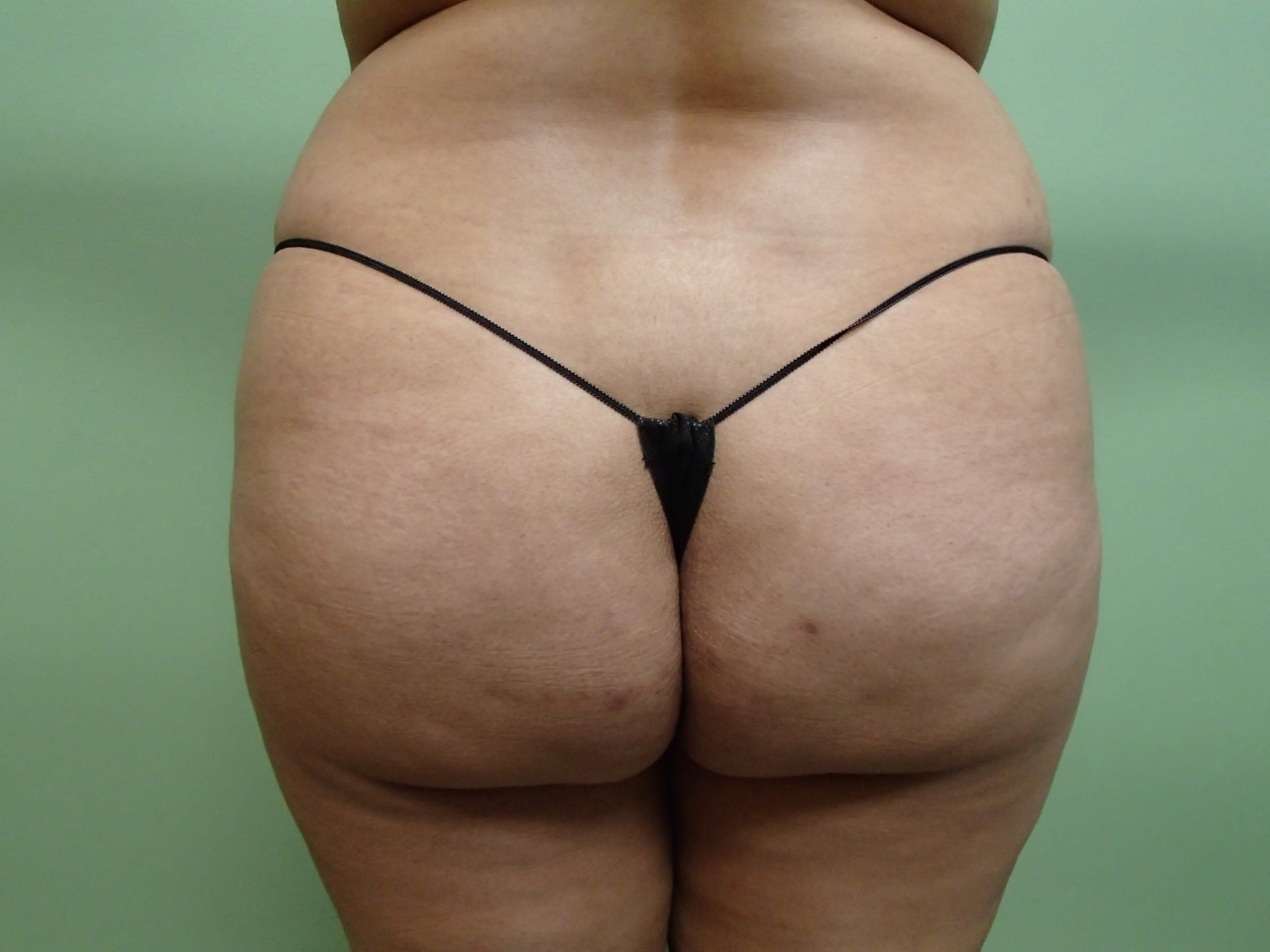Brazilian Butt Lift (BBL) Before