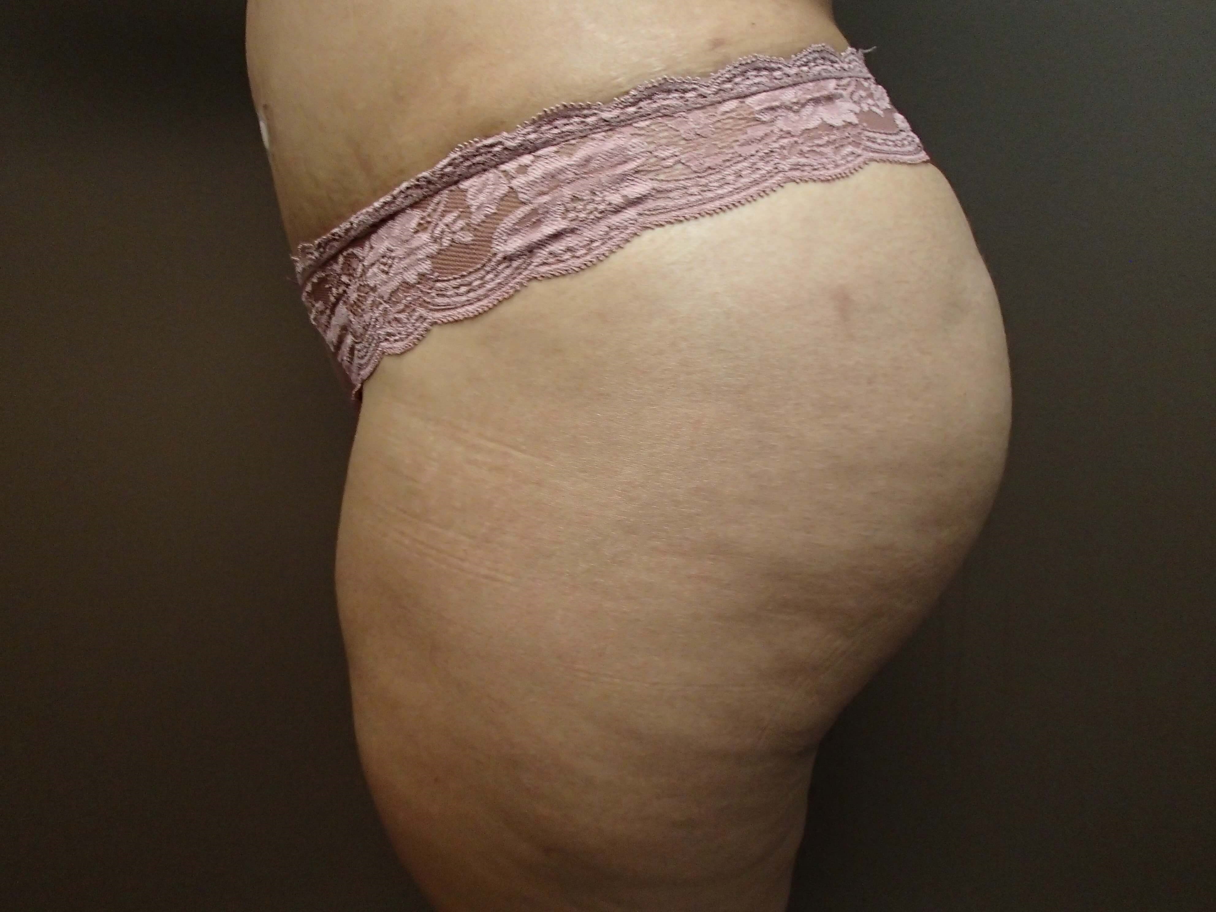 Brazilian Butt Lift (BBL) After