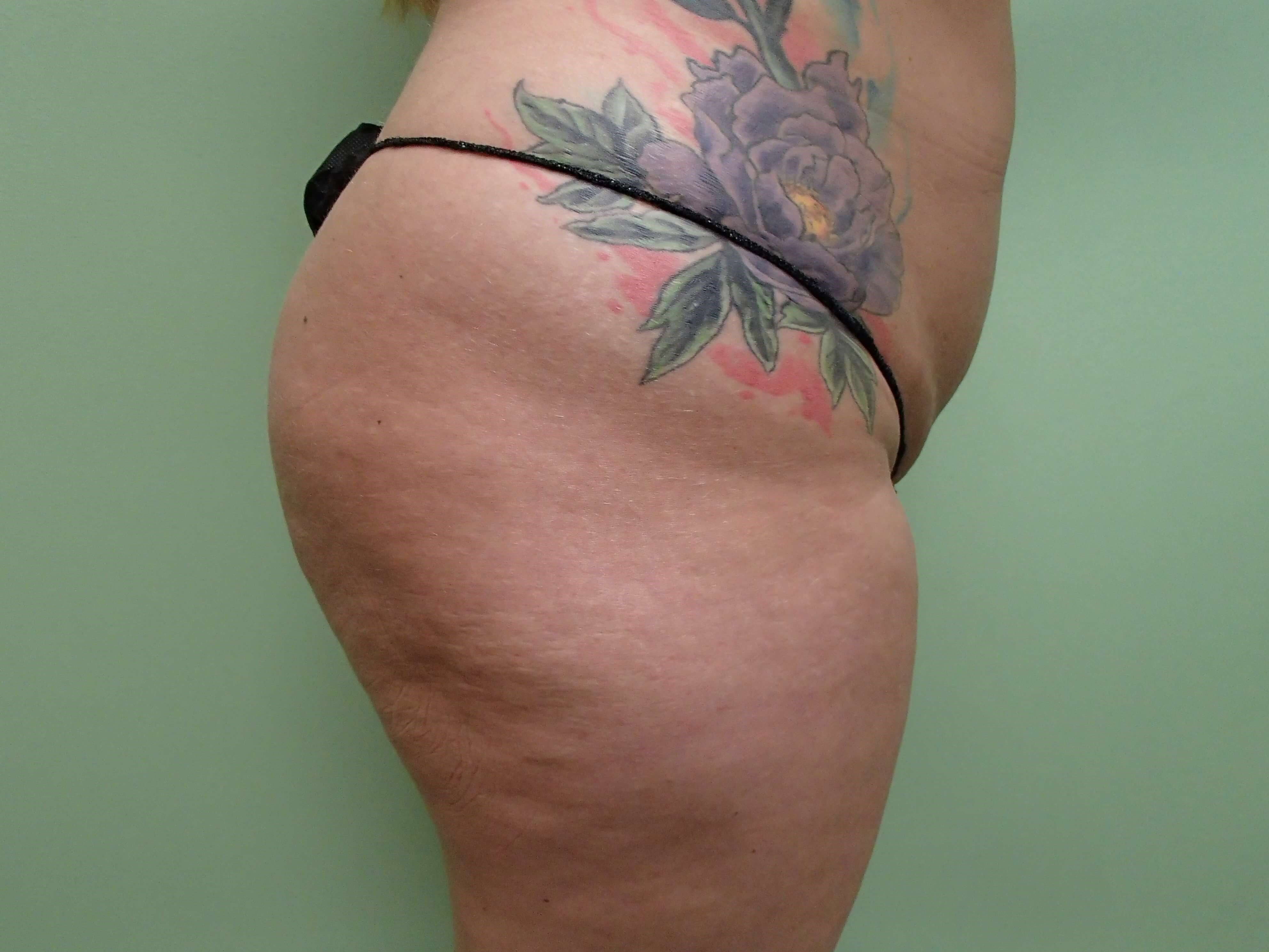 Brazilian Butt Lift (BBL) Before