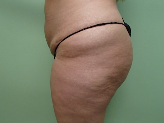 Brazilian Butt Lift (BBL) Before