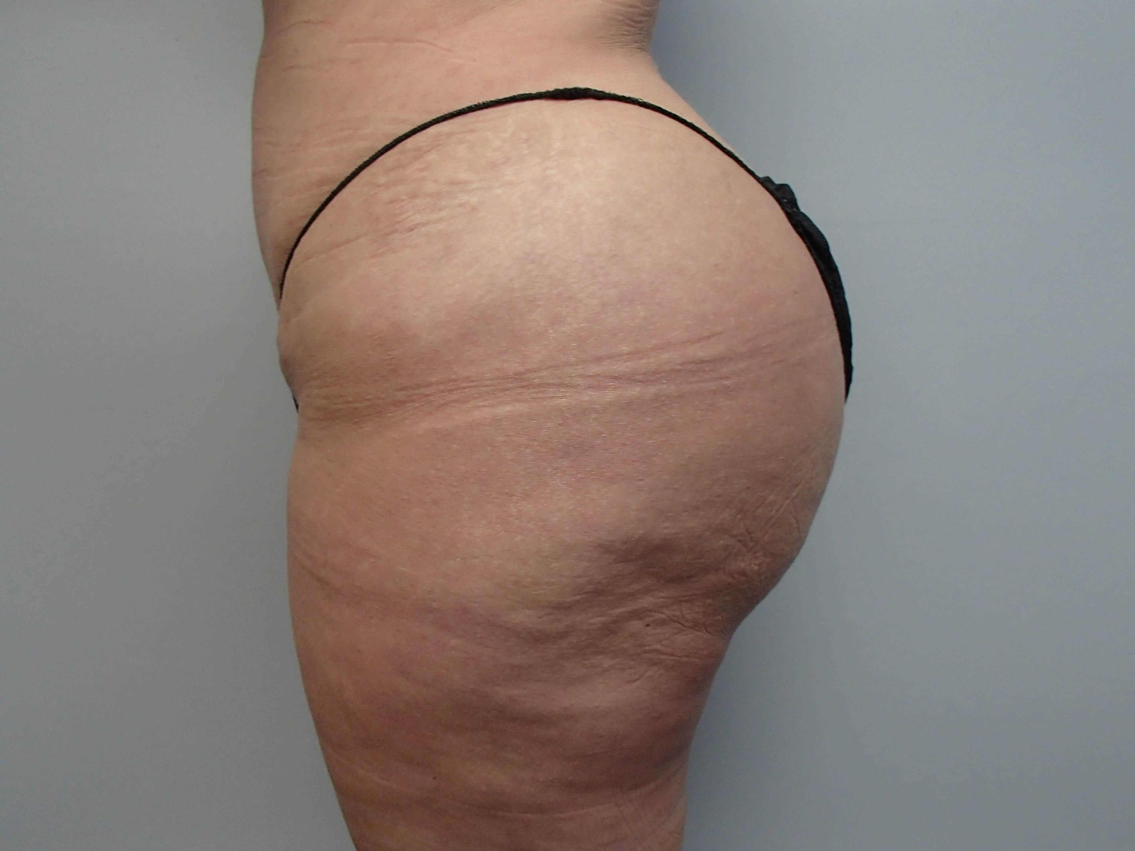 Brazilian Butt Lift (BBL) After