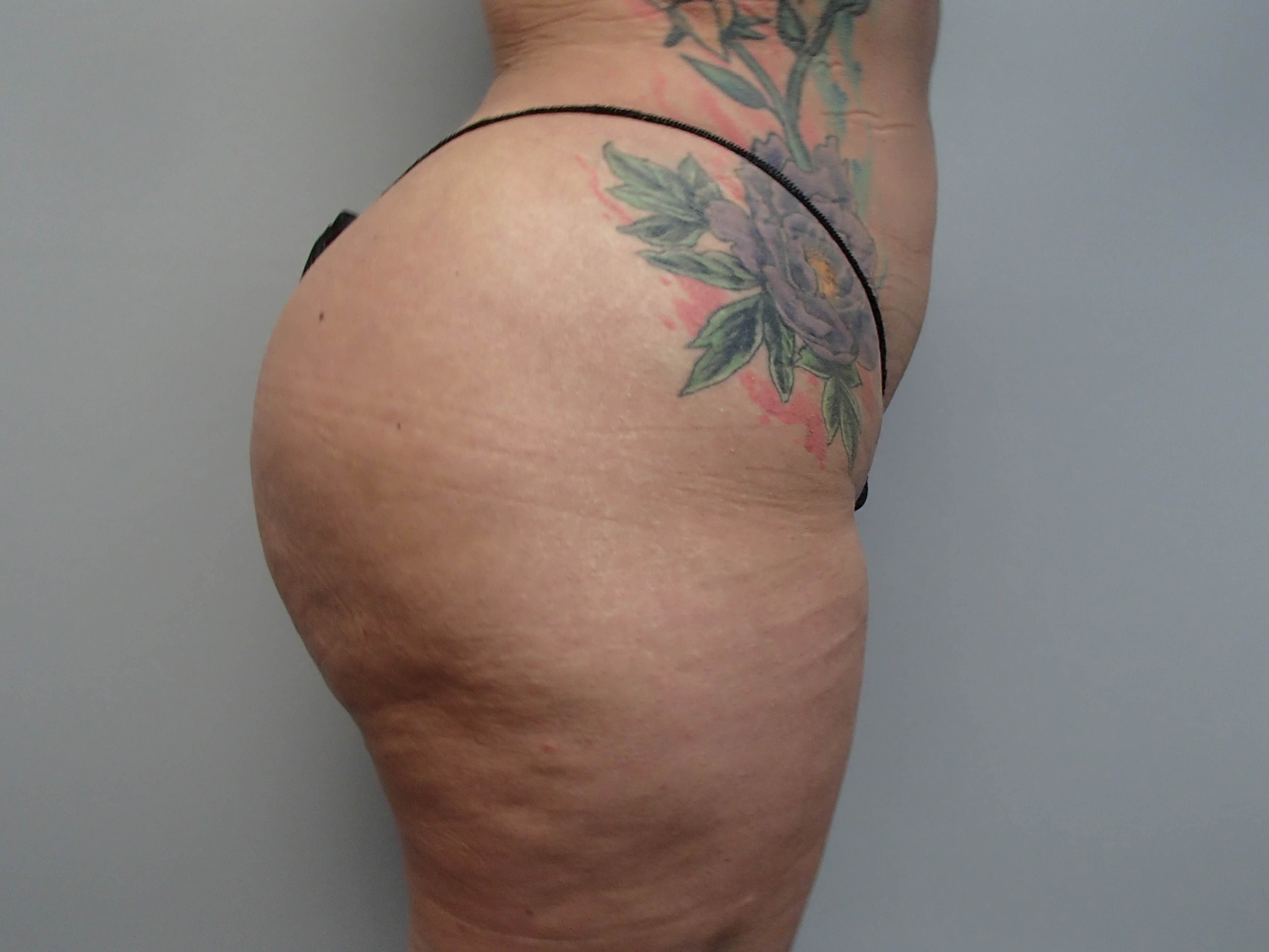 Brazilian Butt Lift (BBL) After