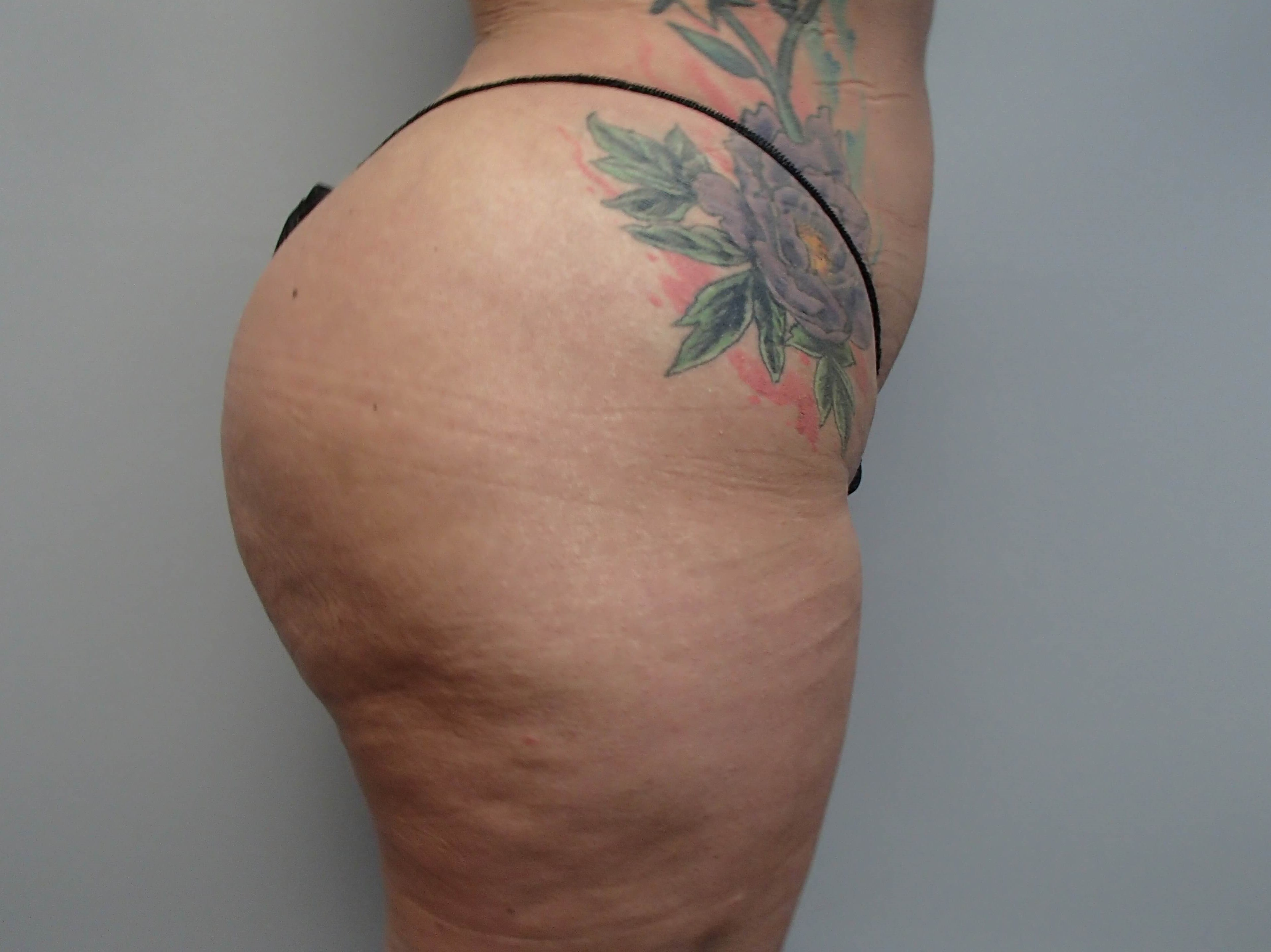 Brazilian Butt Lift (BBL) After