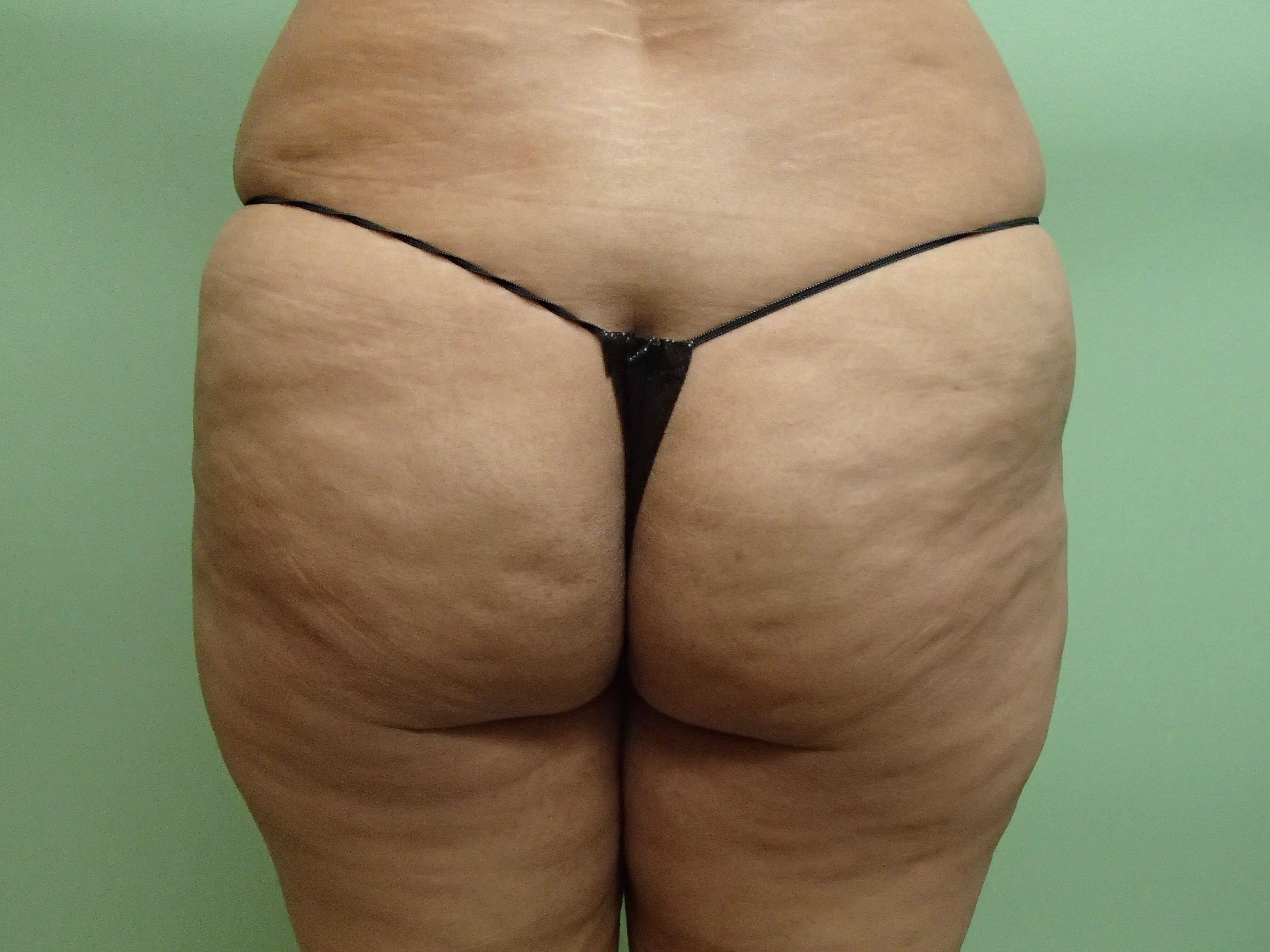 Brazilian Butt Lift (BBL) Before