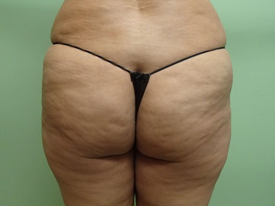 Brazilian Butt Lift (BBL) Before