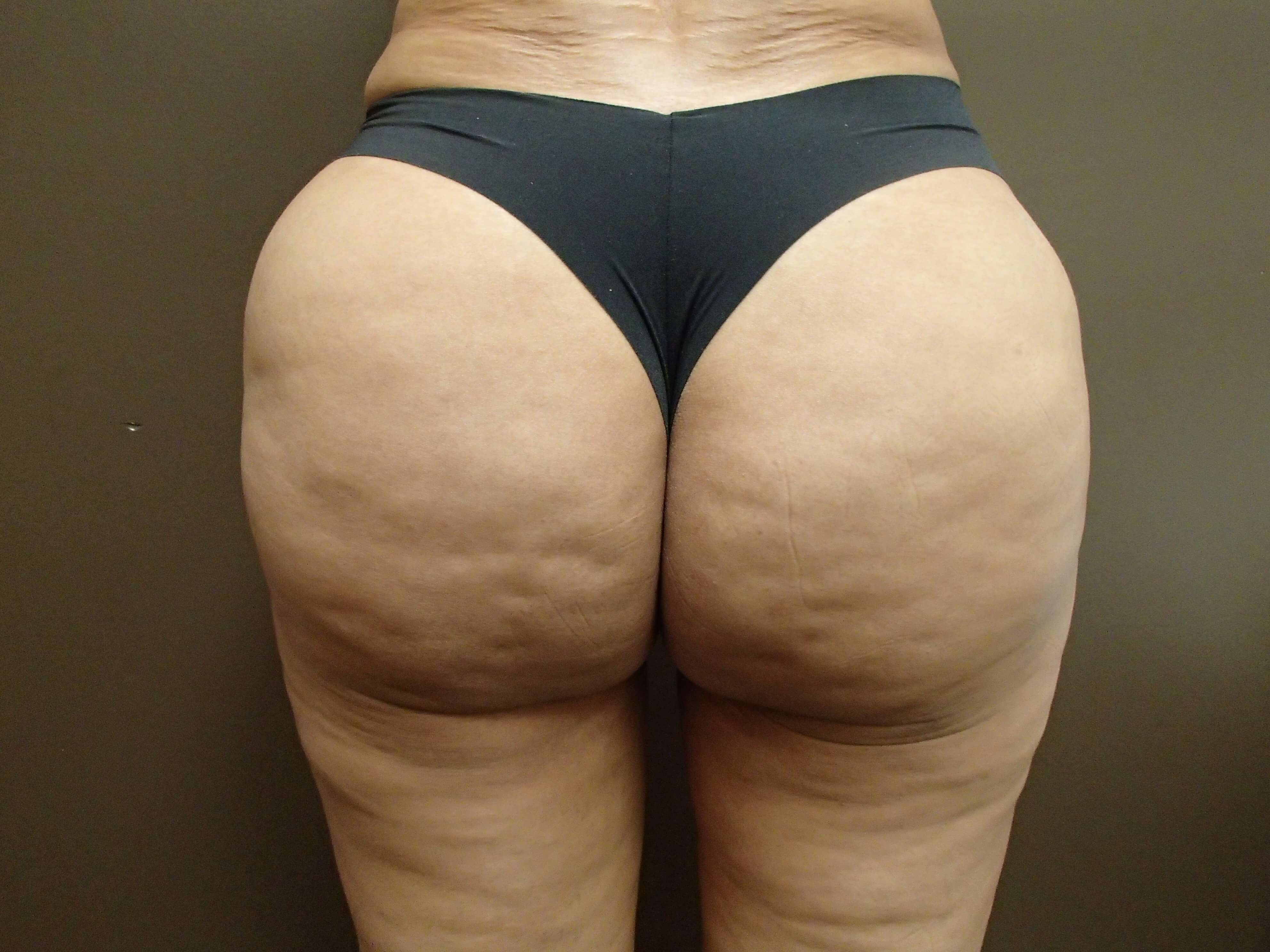 Brazilian Butt Lift (BBL) After
