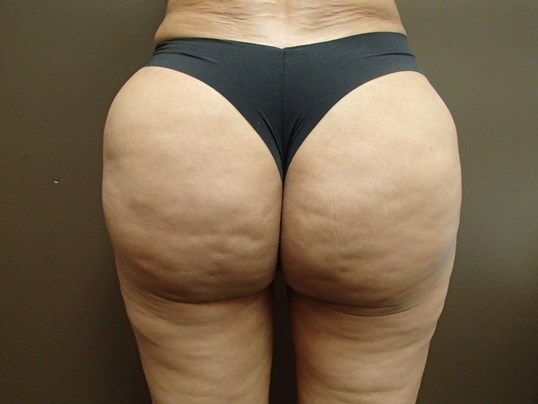 Brazilian Butt Lift (BBL) After
