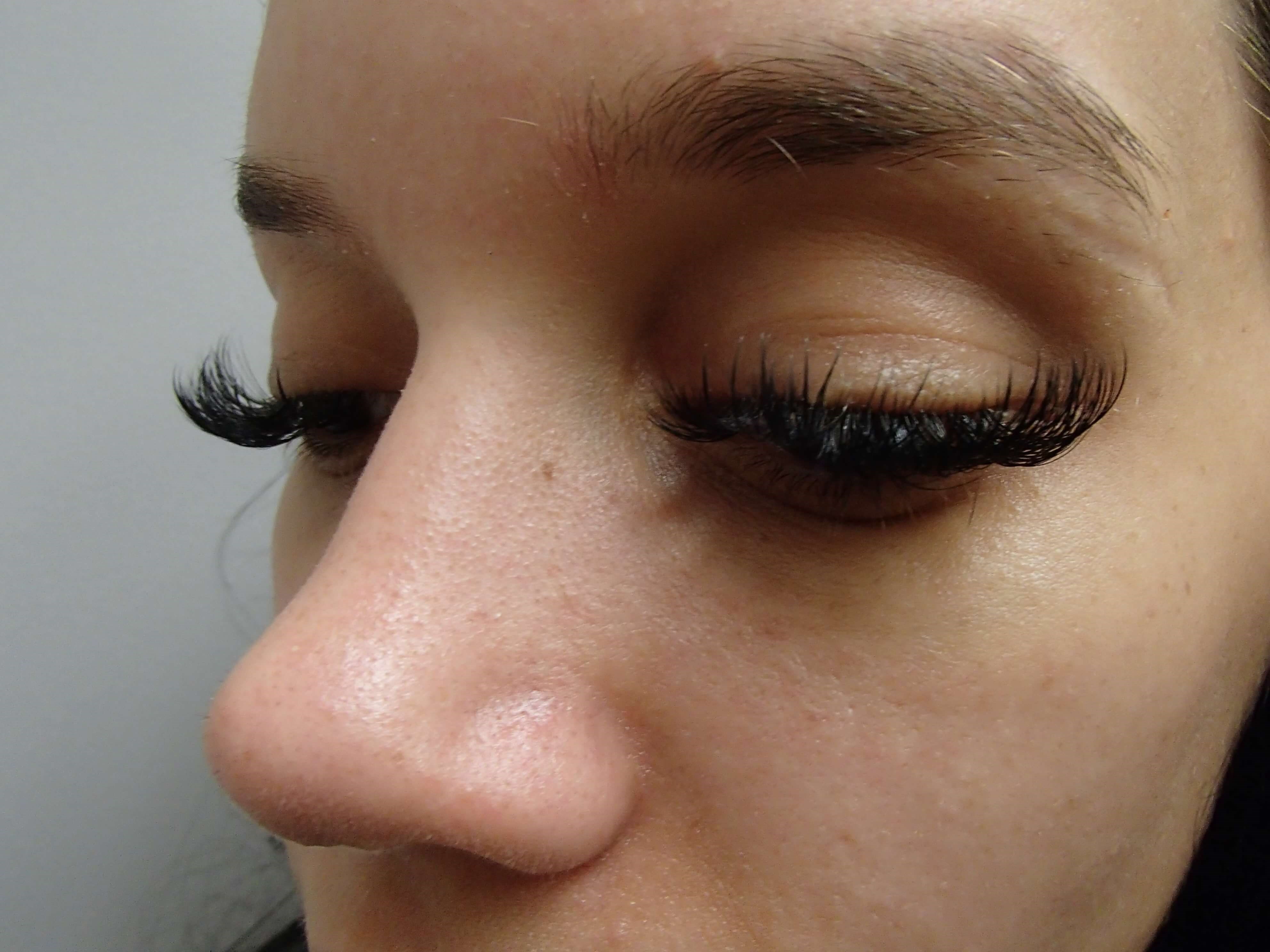 Rhinoplasty (Nose Job) After