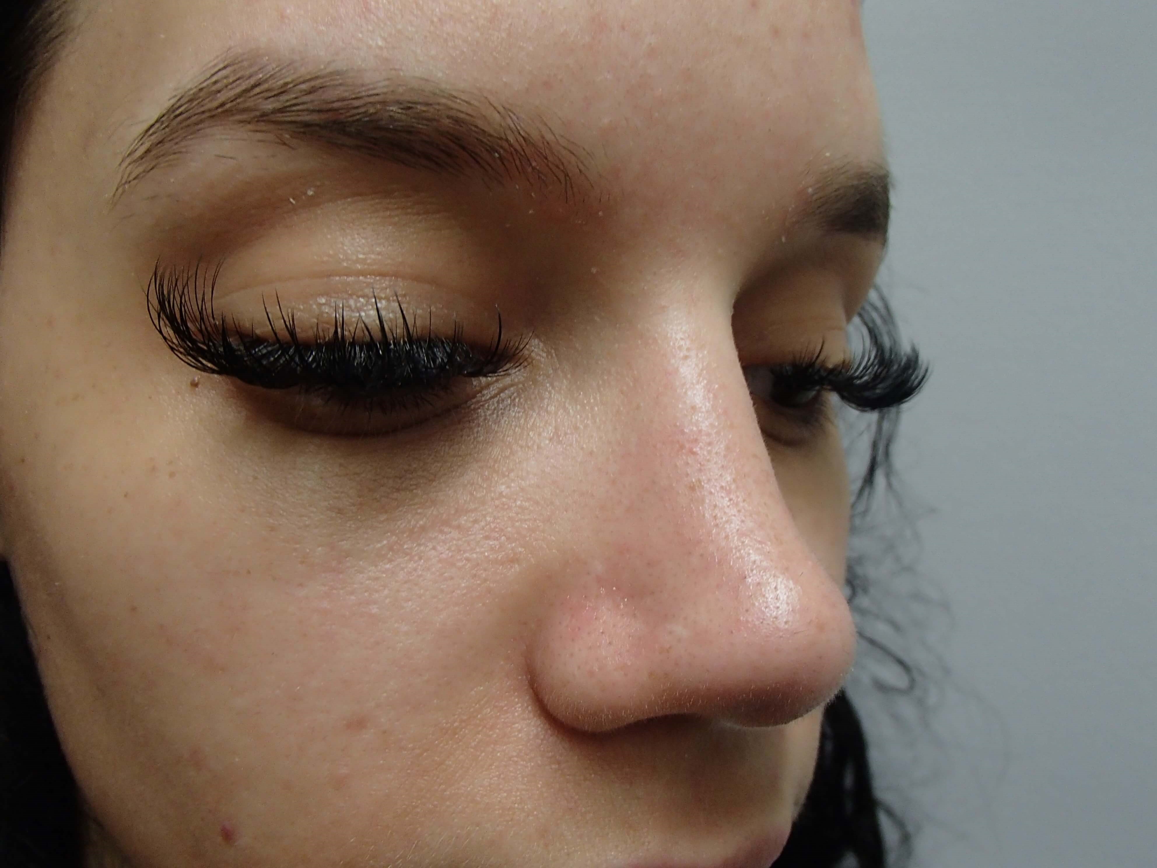 Rhinoplasty (Nose Job) After