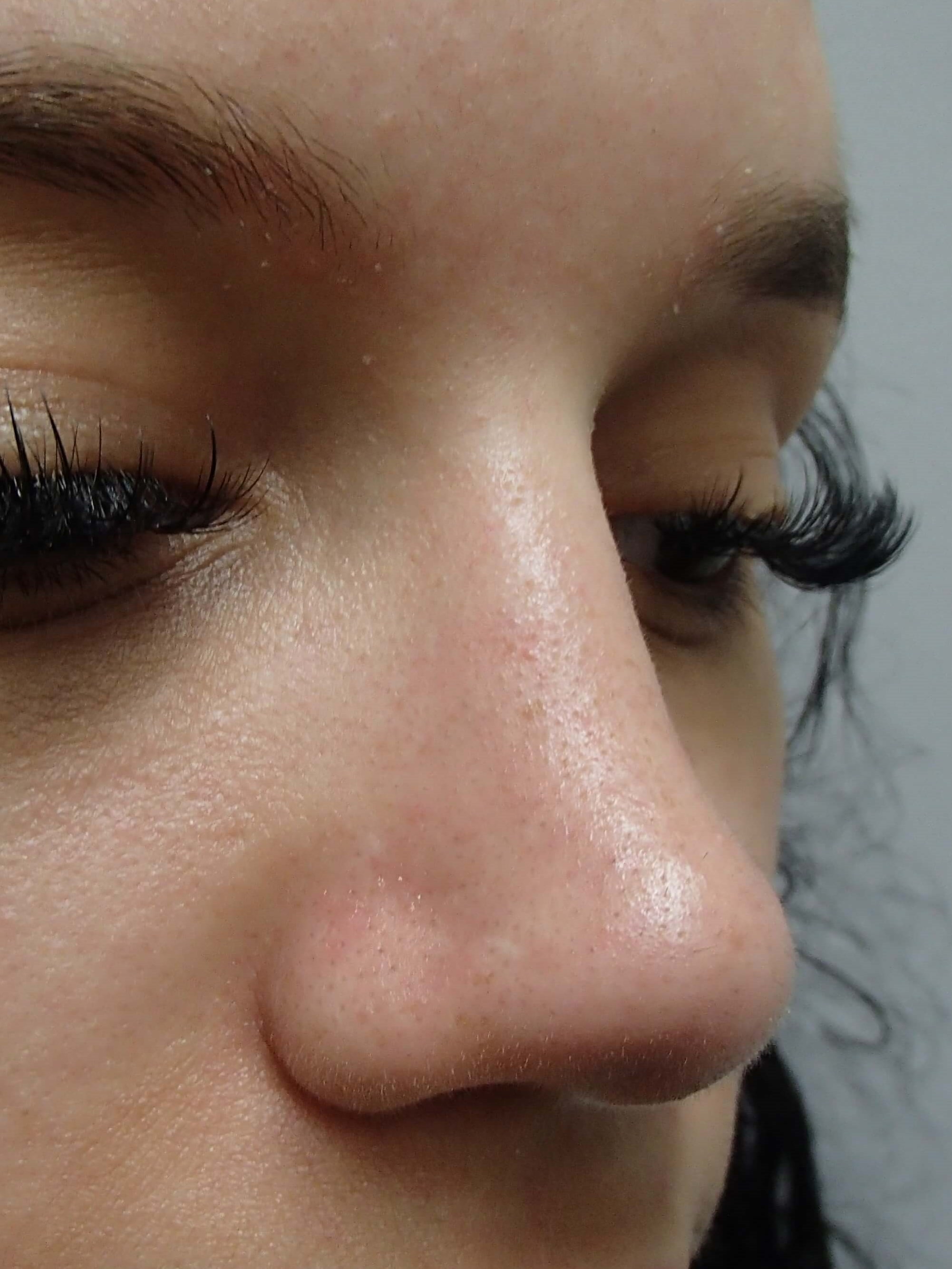 Rhinoplasty (Nose Job) After