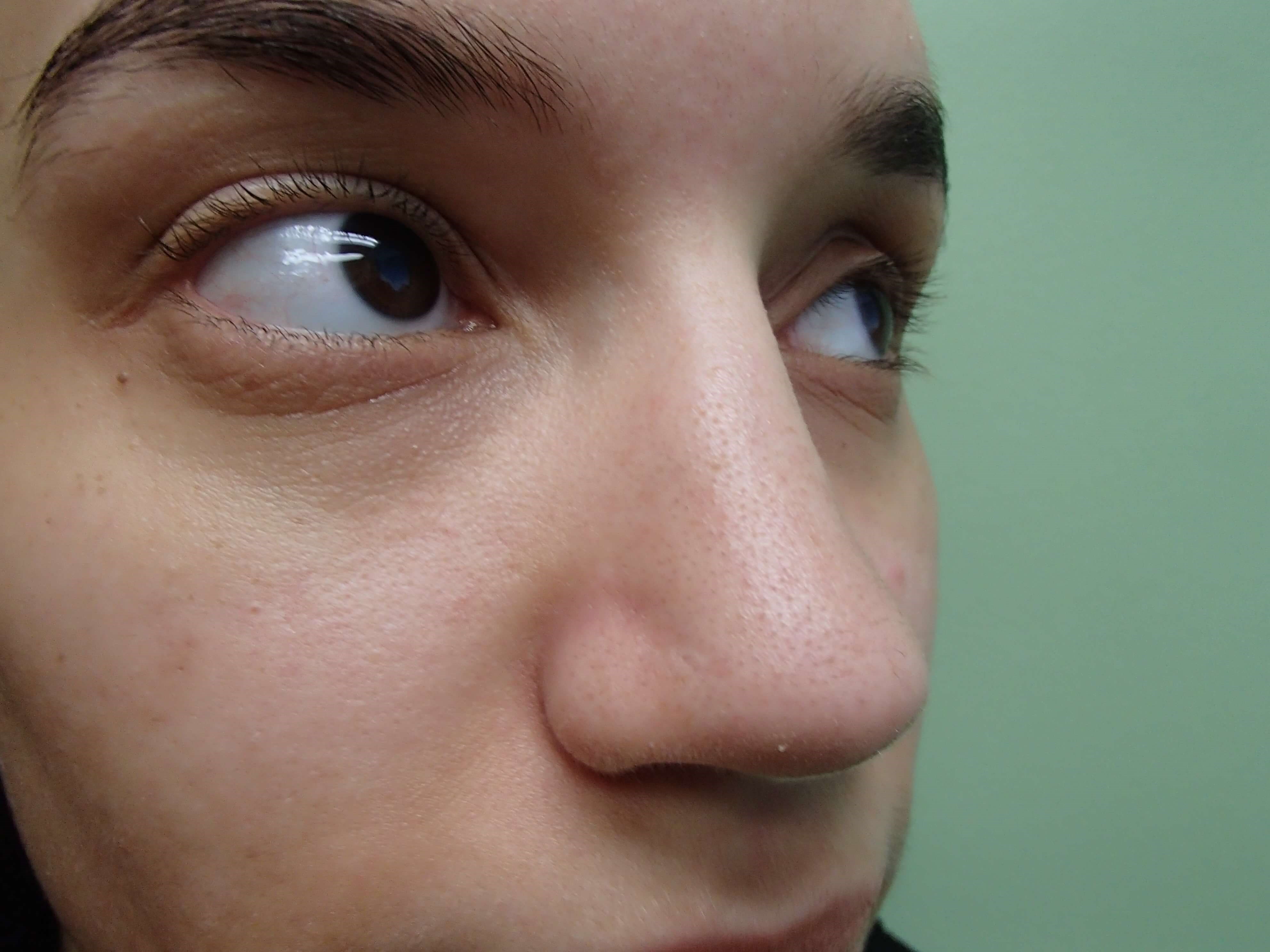 Rhinoplasty (Nose Job) Before