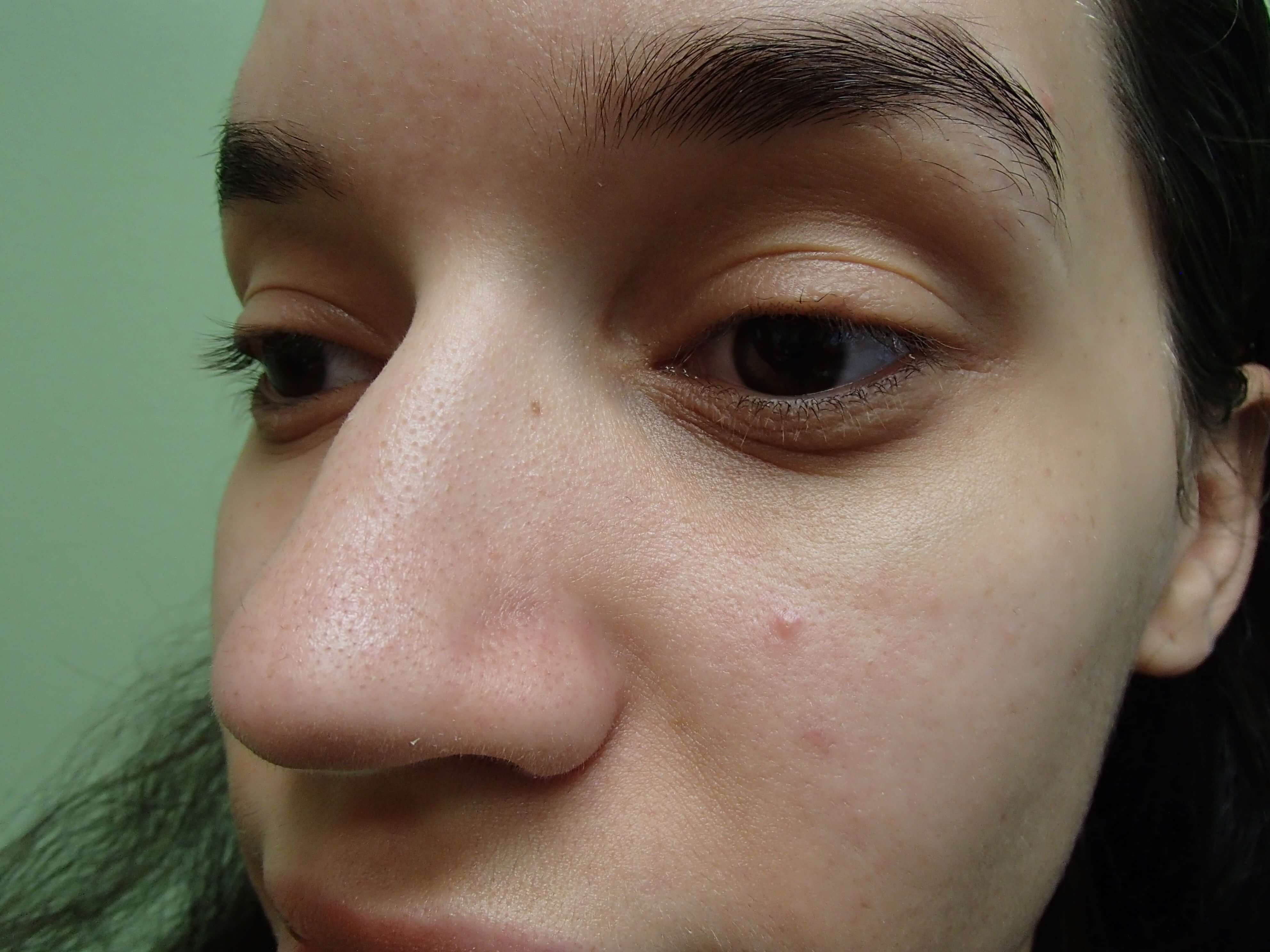 Rhinoplasty (Nose Job) Before