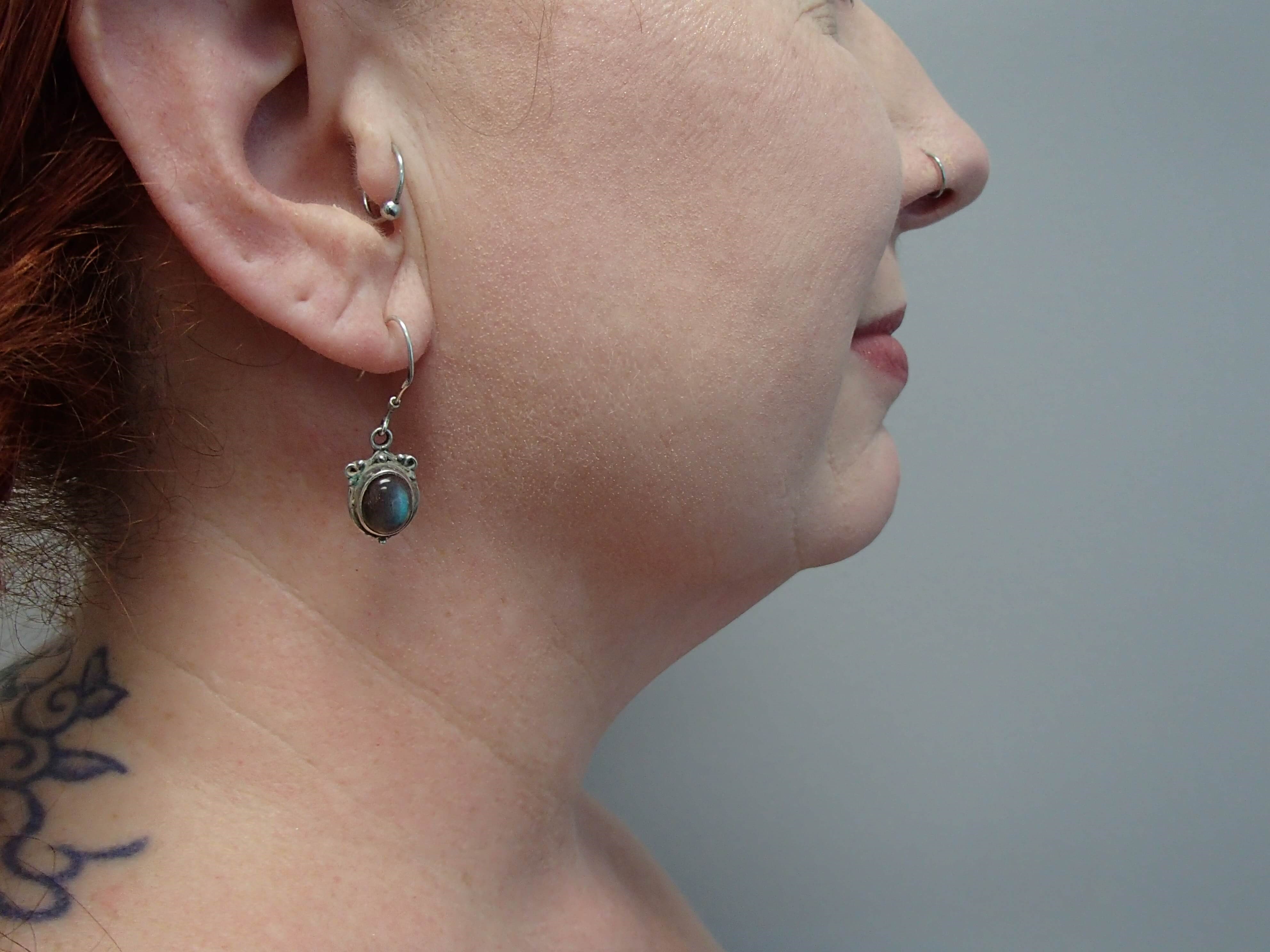 Liposuction to Neck/Jowls Before