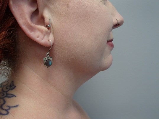 Liposuction to Neck/Jowls Before