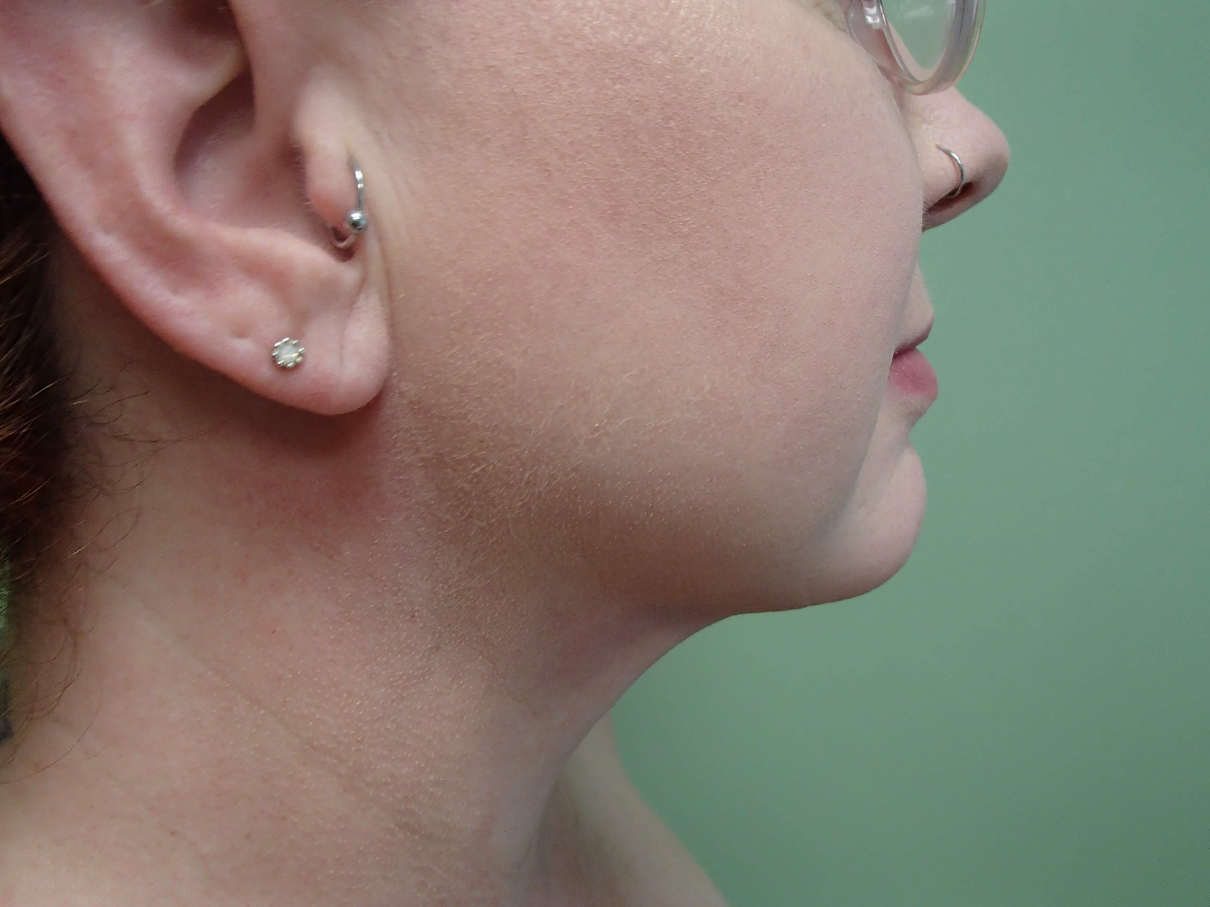 Liposuction to Neck/Jowls After