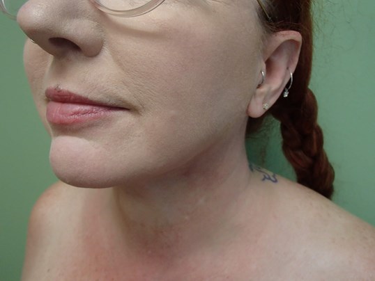 Liposuction to Neck/Jowls After
