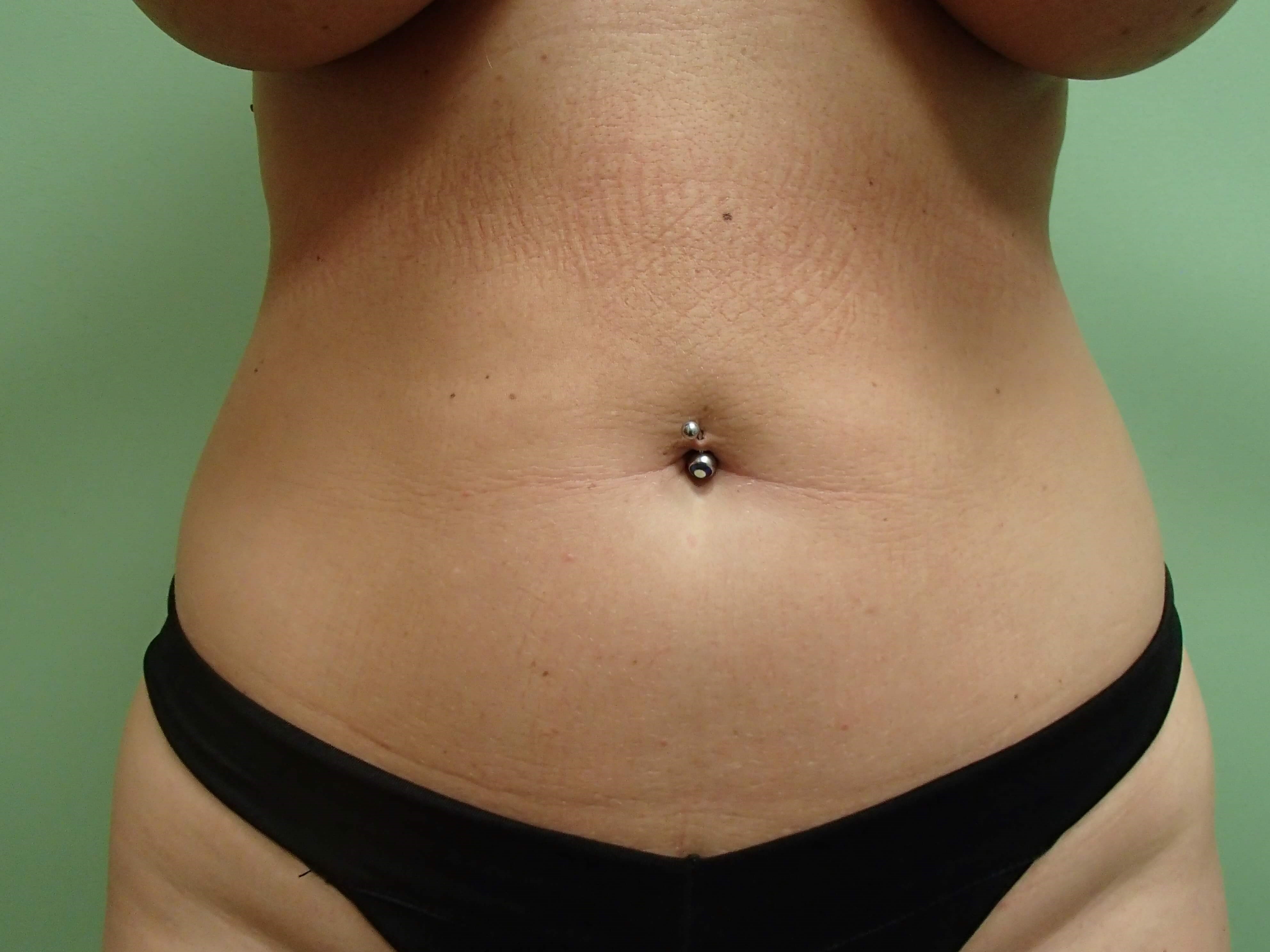 Liposuction Before