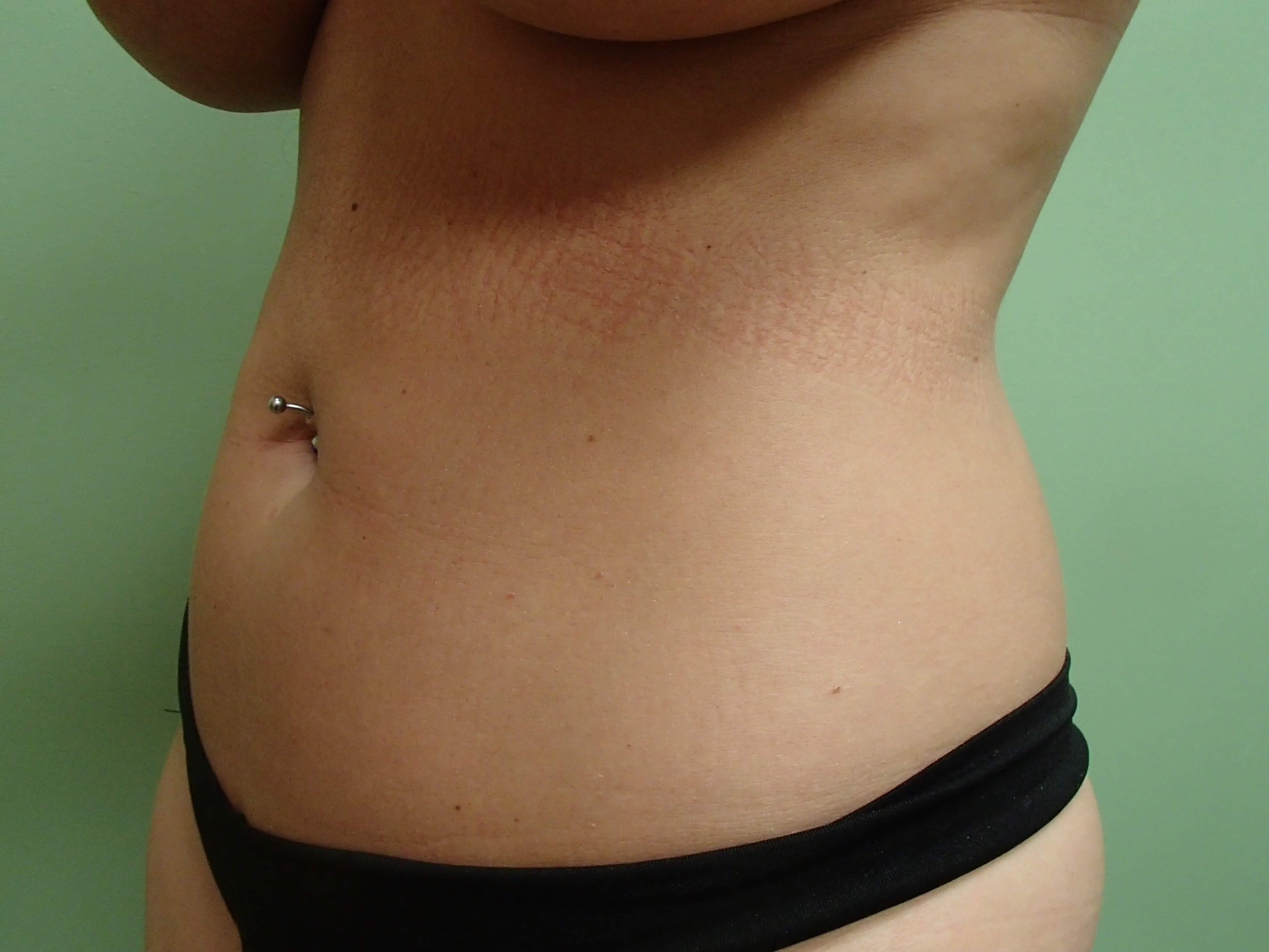 Liposuction Before