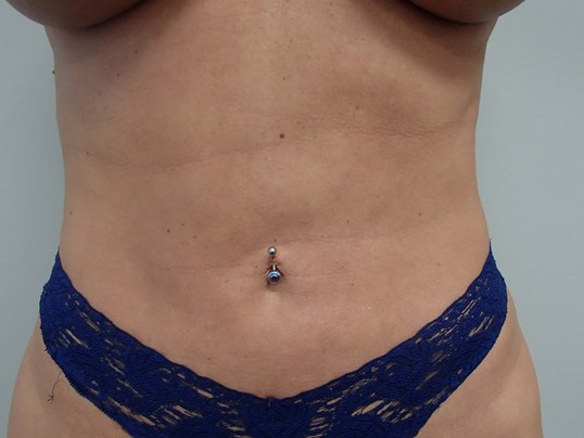 Liposuction After