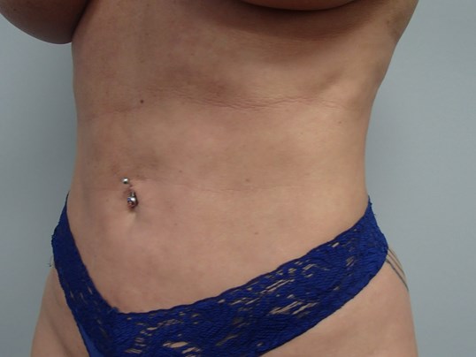 Liposuction After