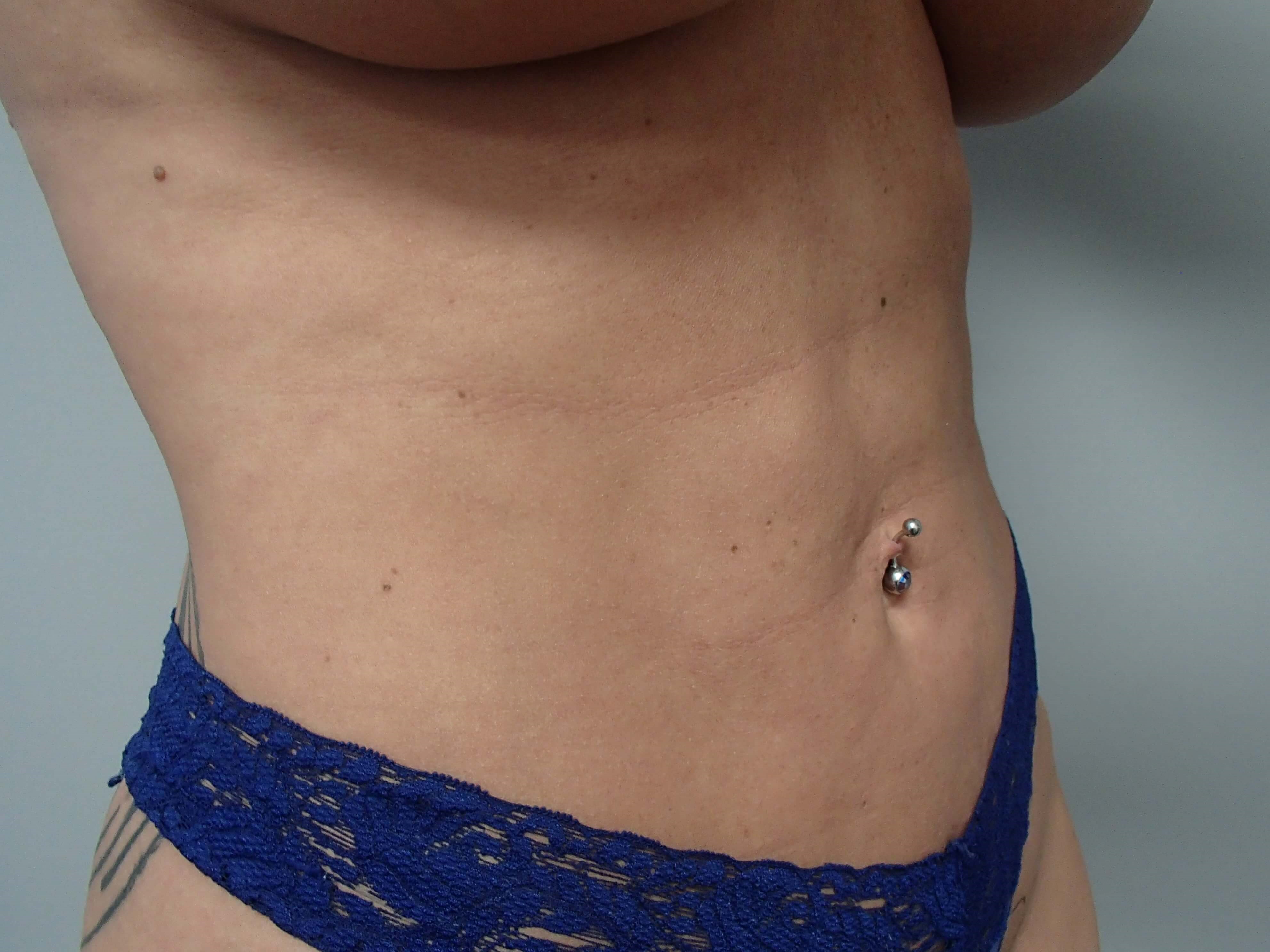 Liposuction After