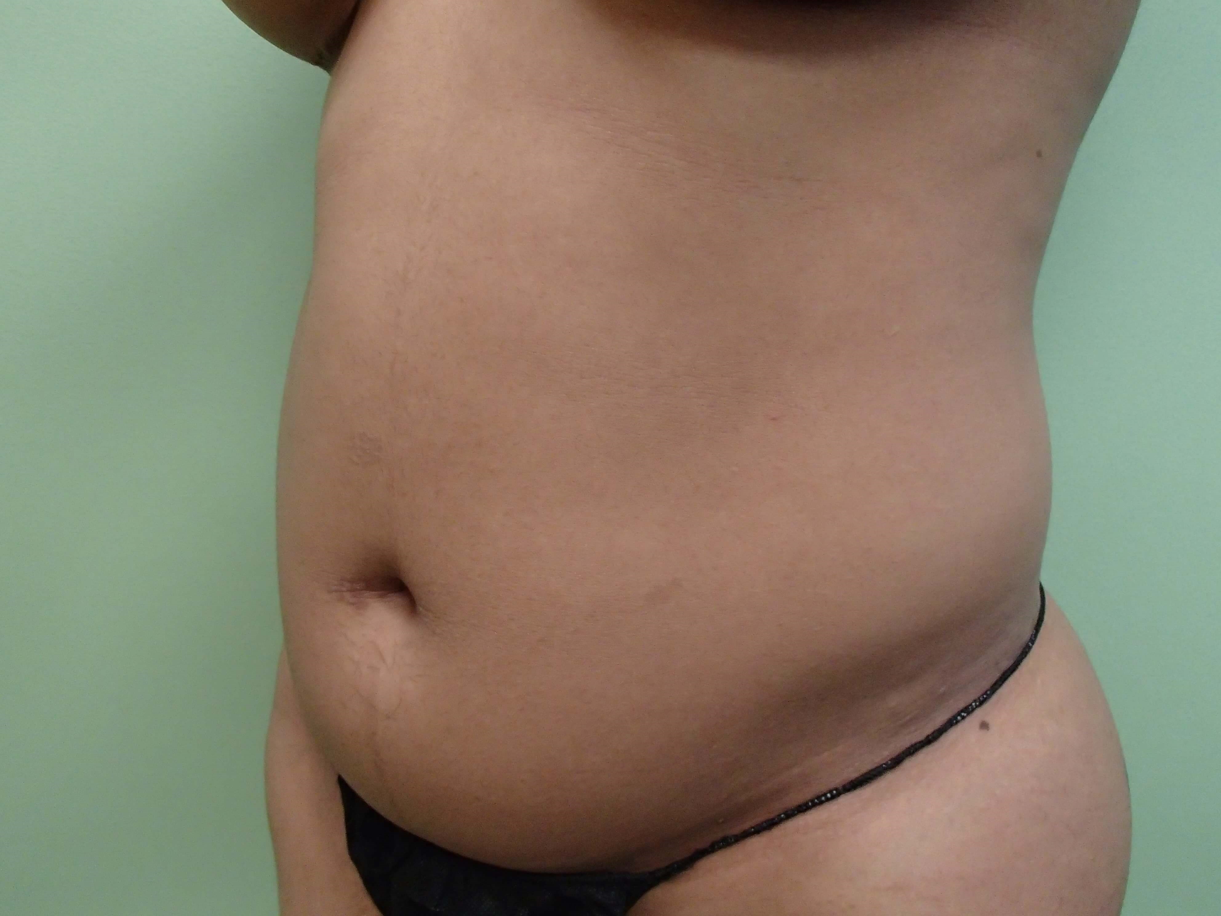 Liposuction Before