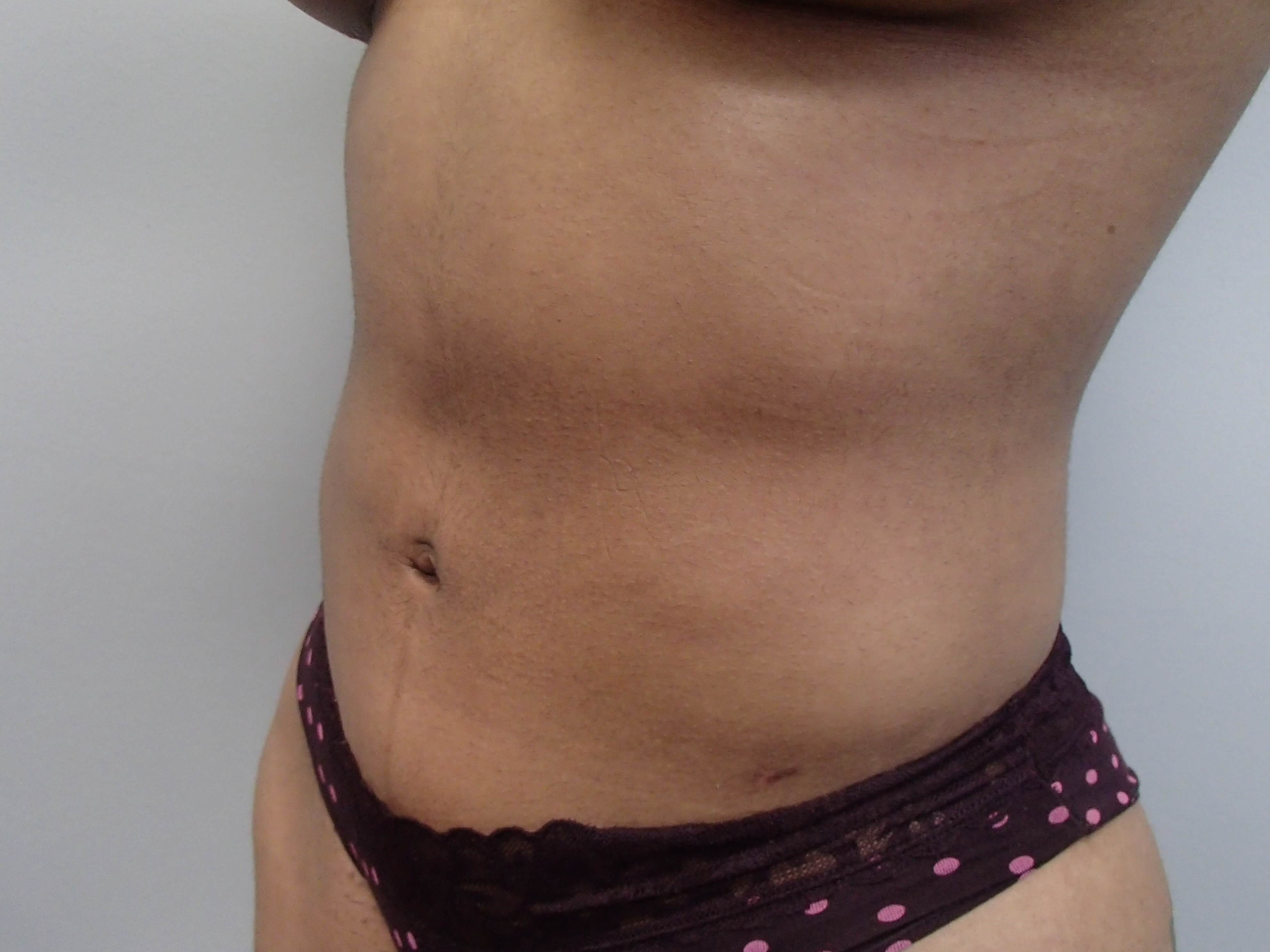 Liposuction After