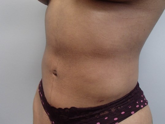 Liposuction After