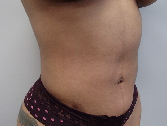 Liposuction After