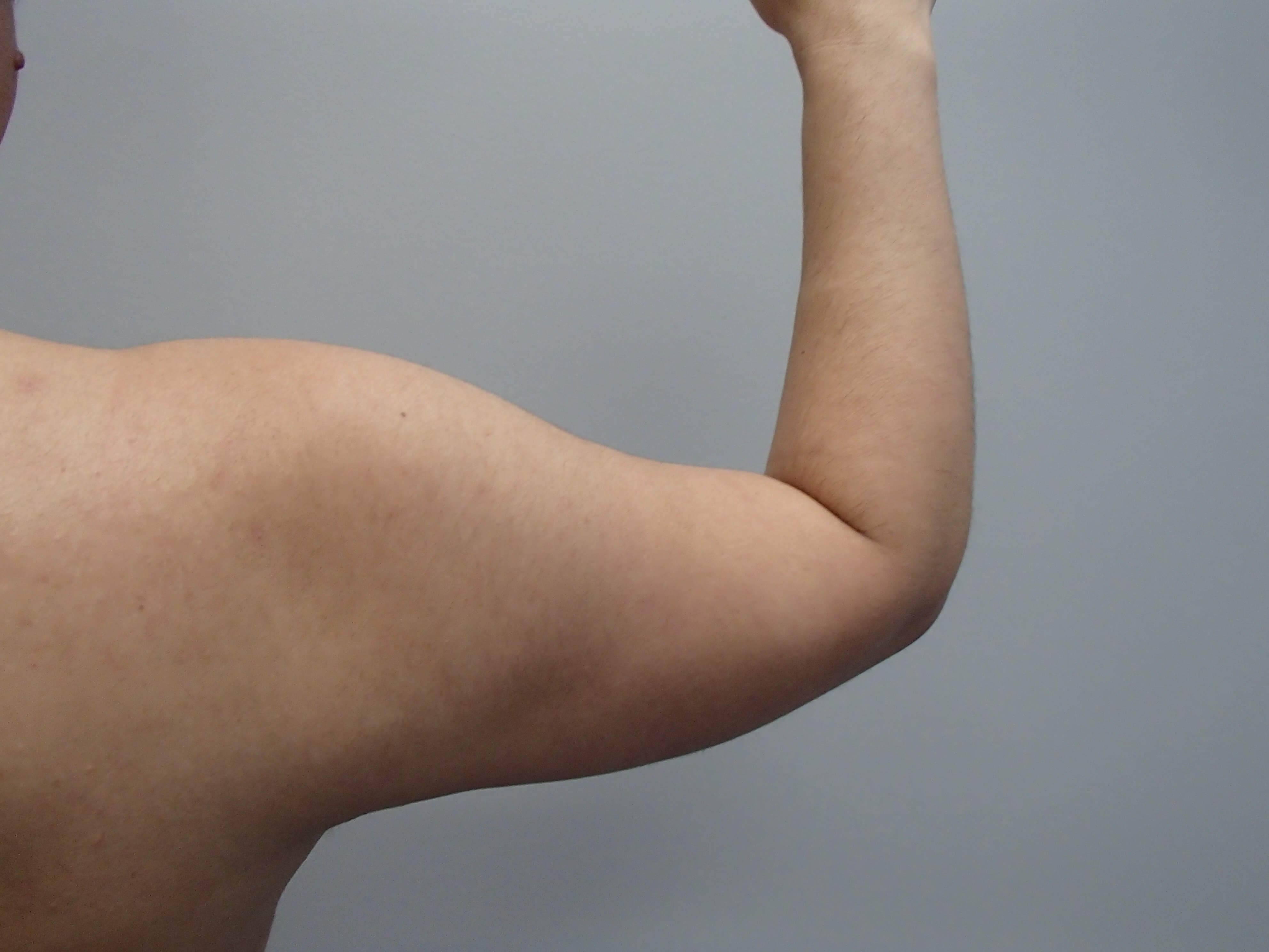 Liposuction Before