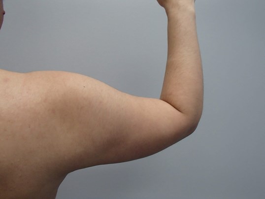 Liposuction Before