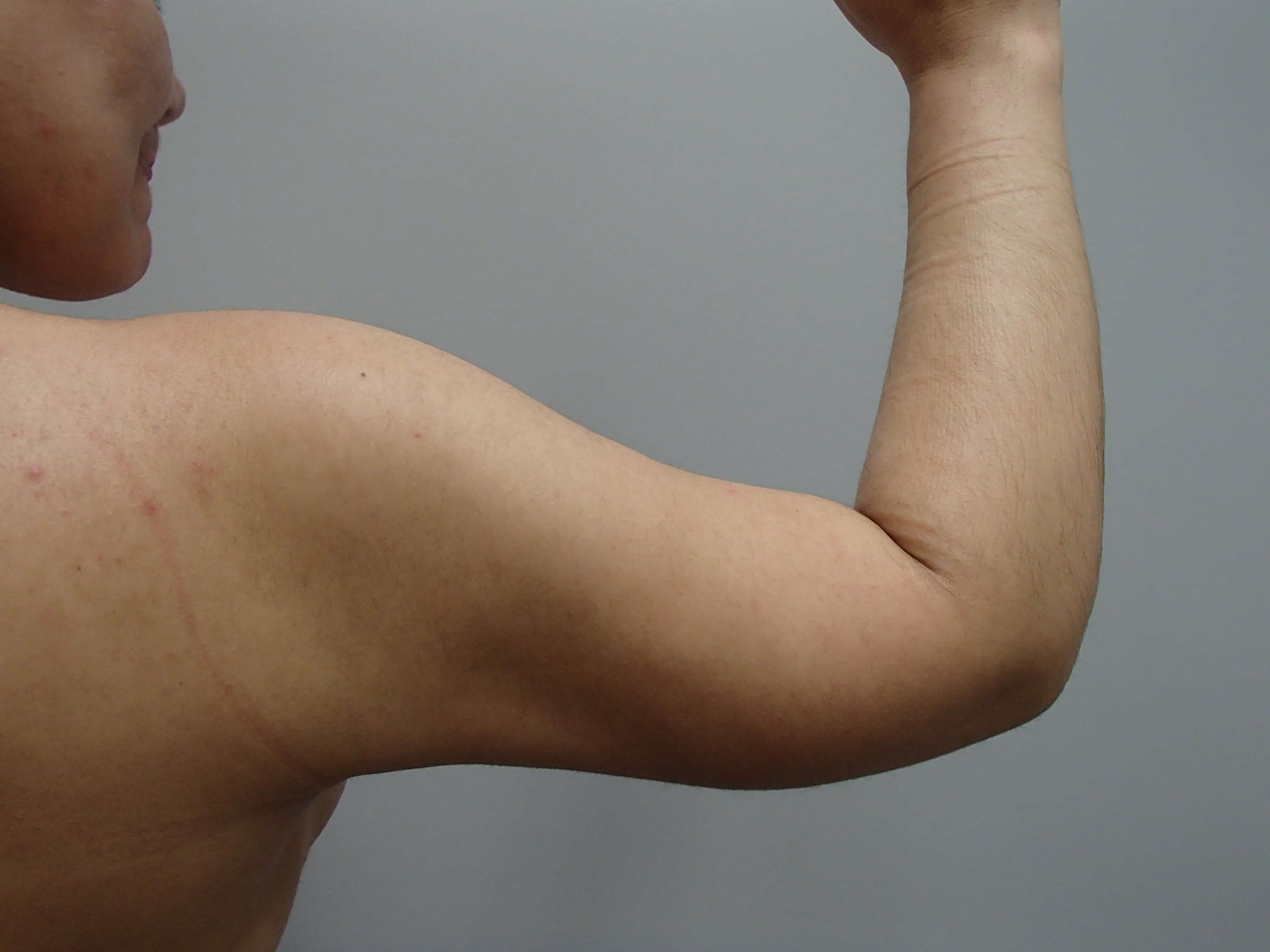 Liposuction After