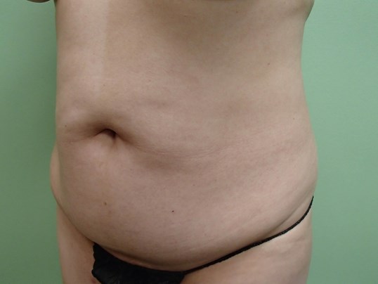 Timeless Tuck - Abdominoplasty Before