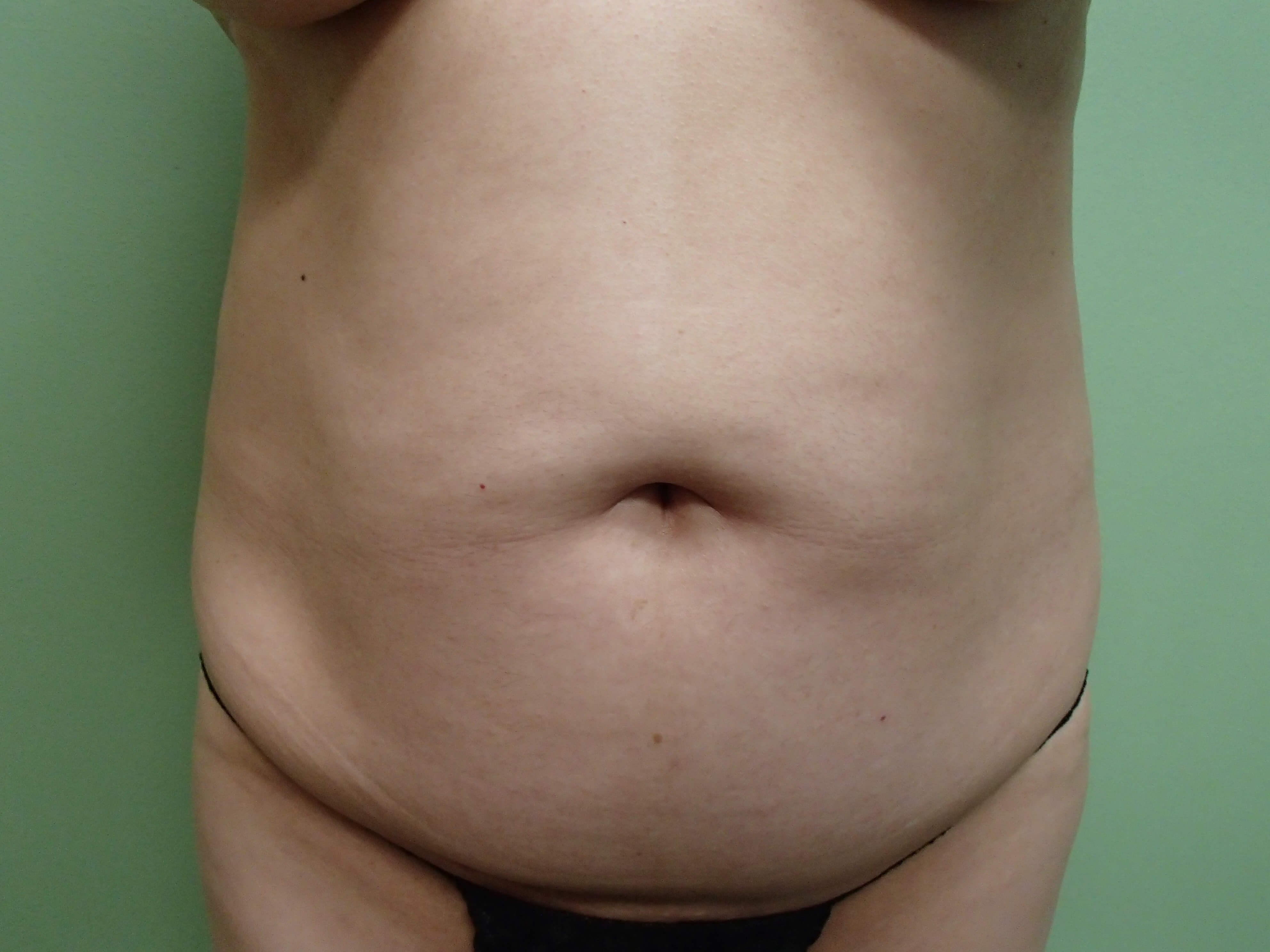 Timeless Tuck - Abdominoplasty Before
