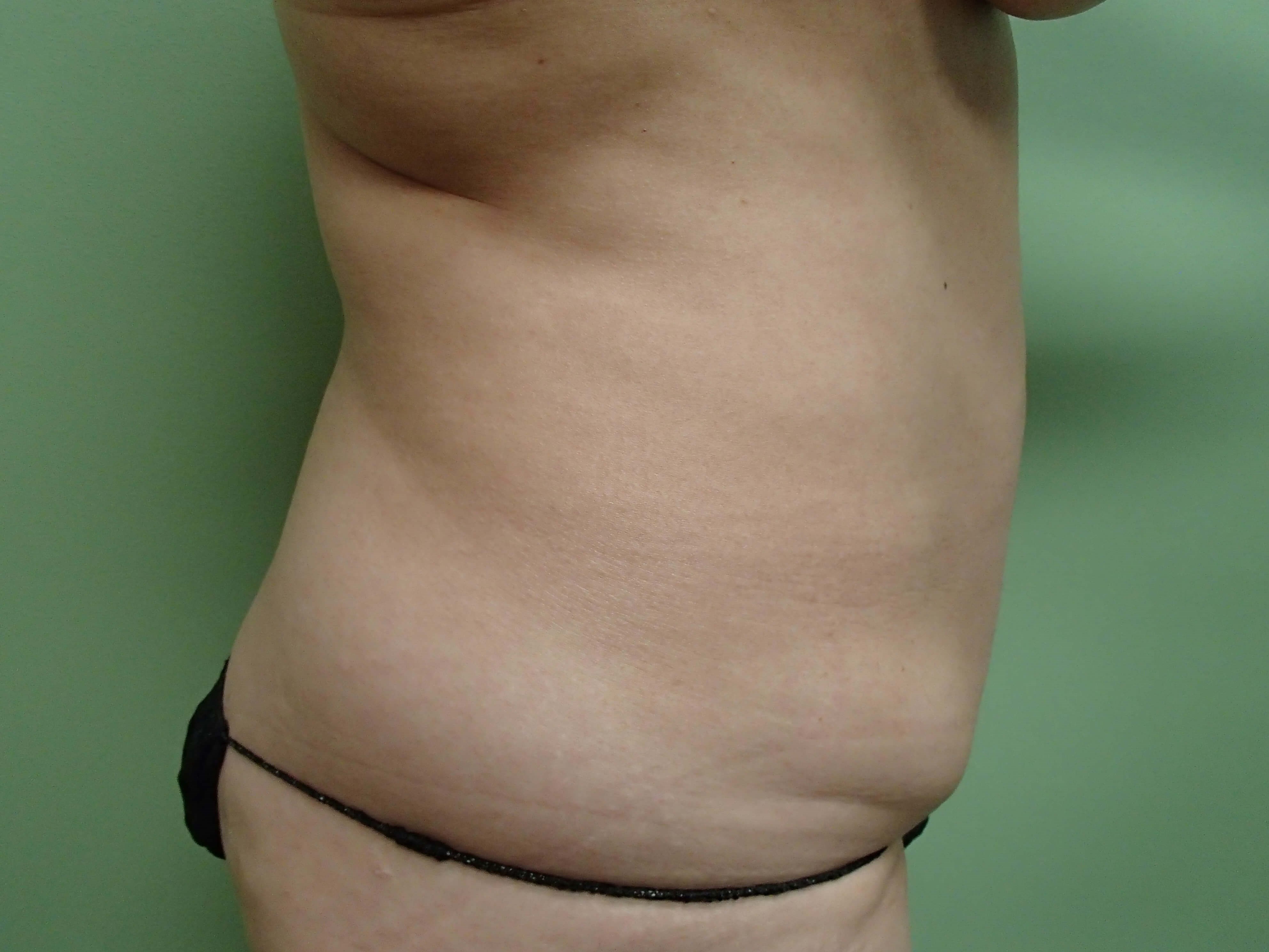 Timeless Tuck - Abdominoplasty Before