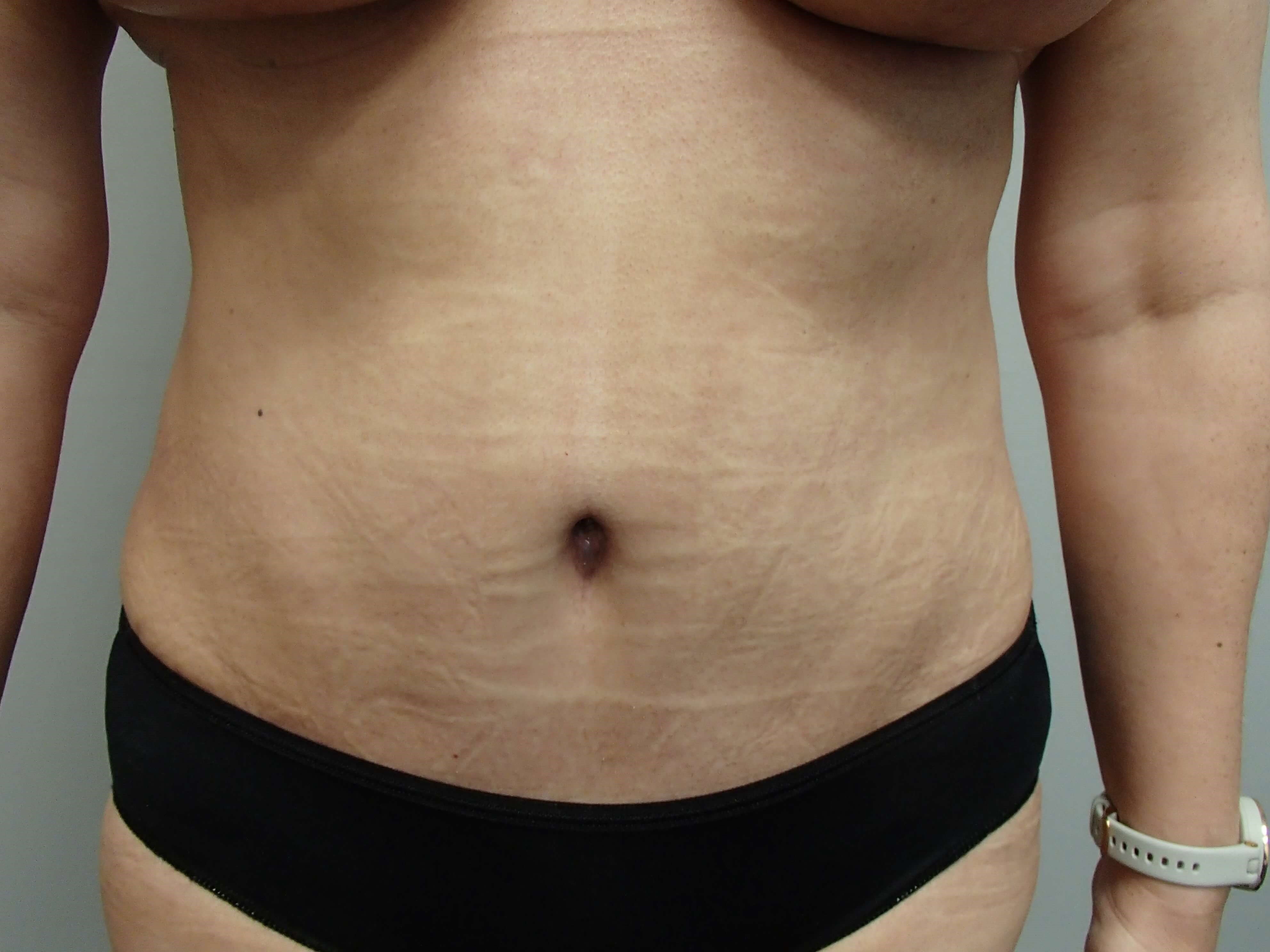 Timeless Tuck - Abdominoplasty After