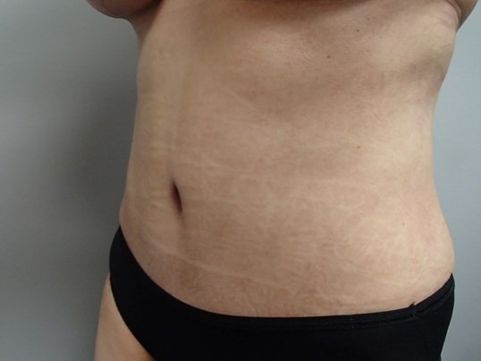 Timeless Tuck - Abdominoplasty After