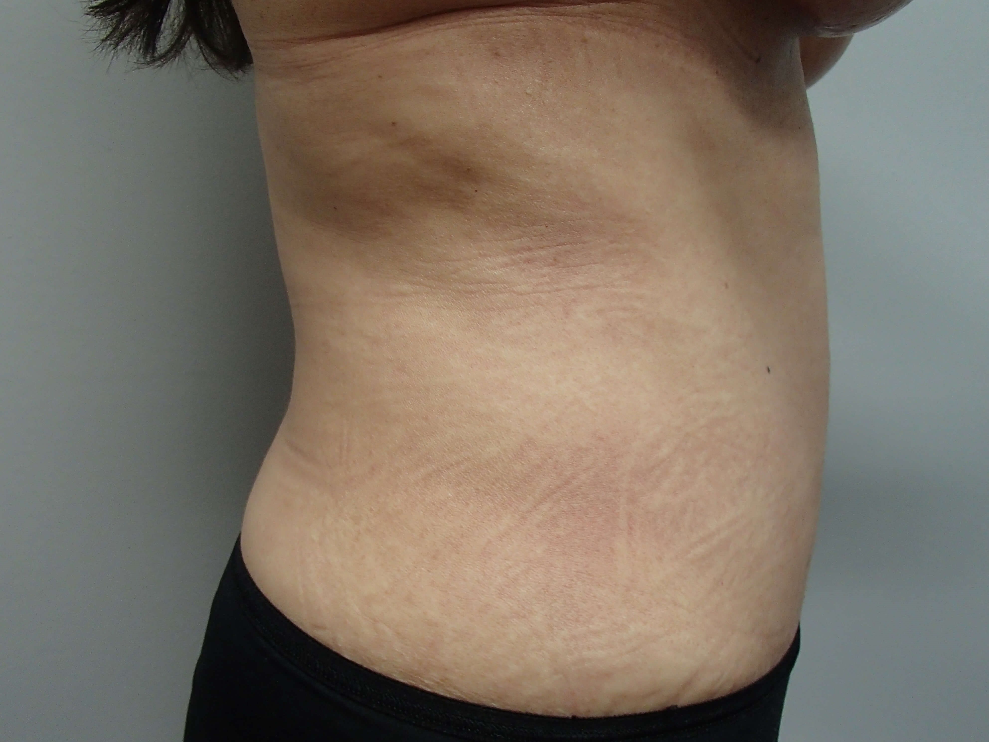 Timeless Tuck - Abdominoplasty After