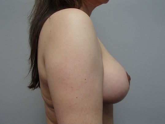 Breast Lift with Fat Transfer After