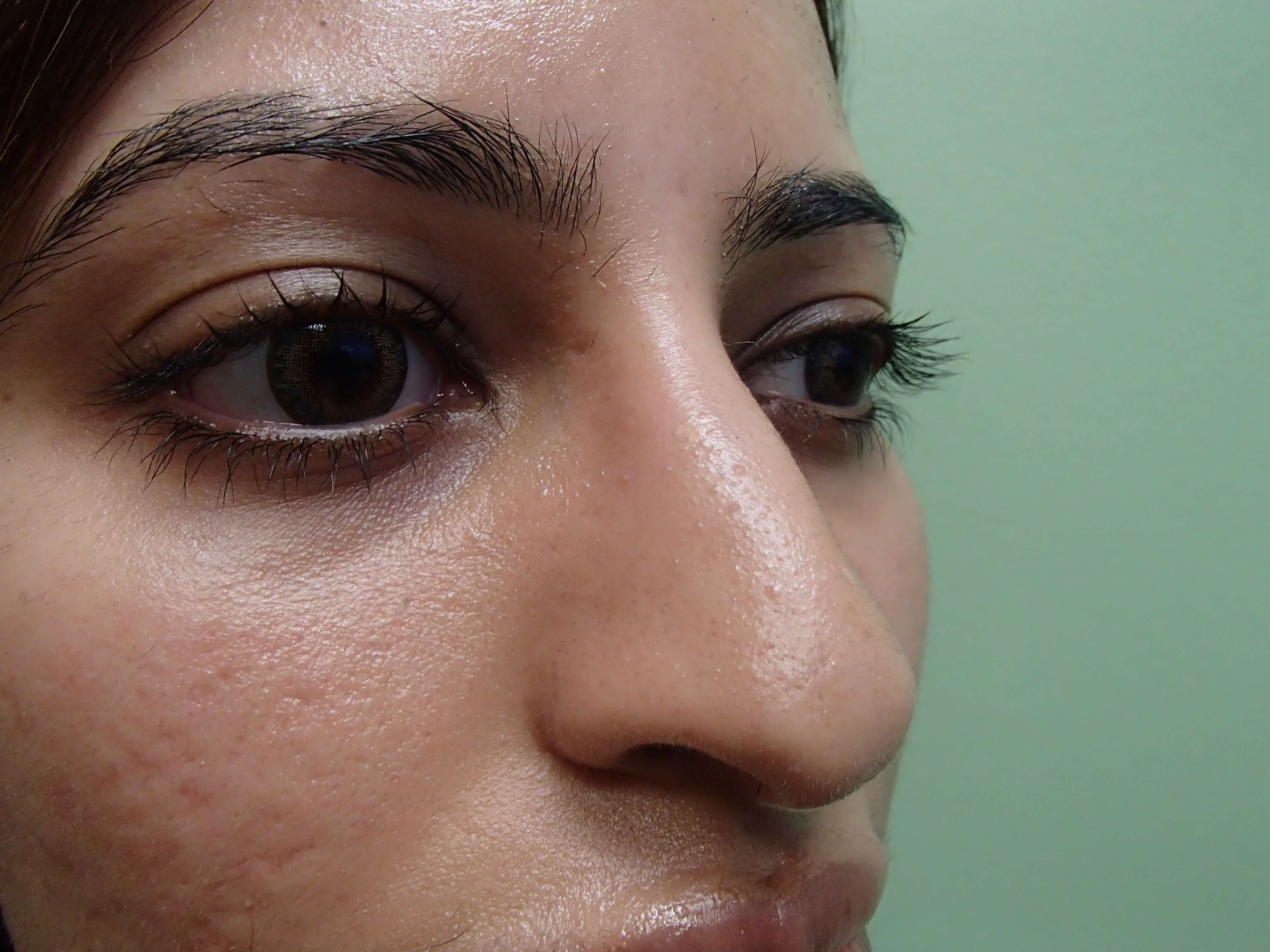 Rhinoplasty Before