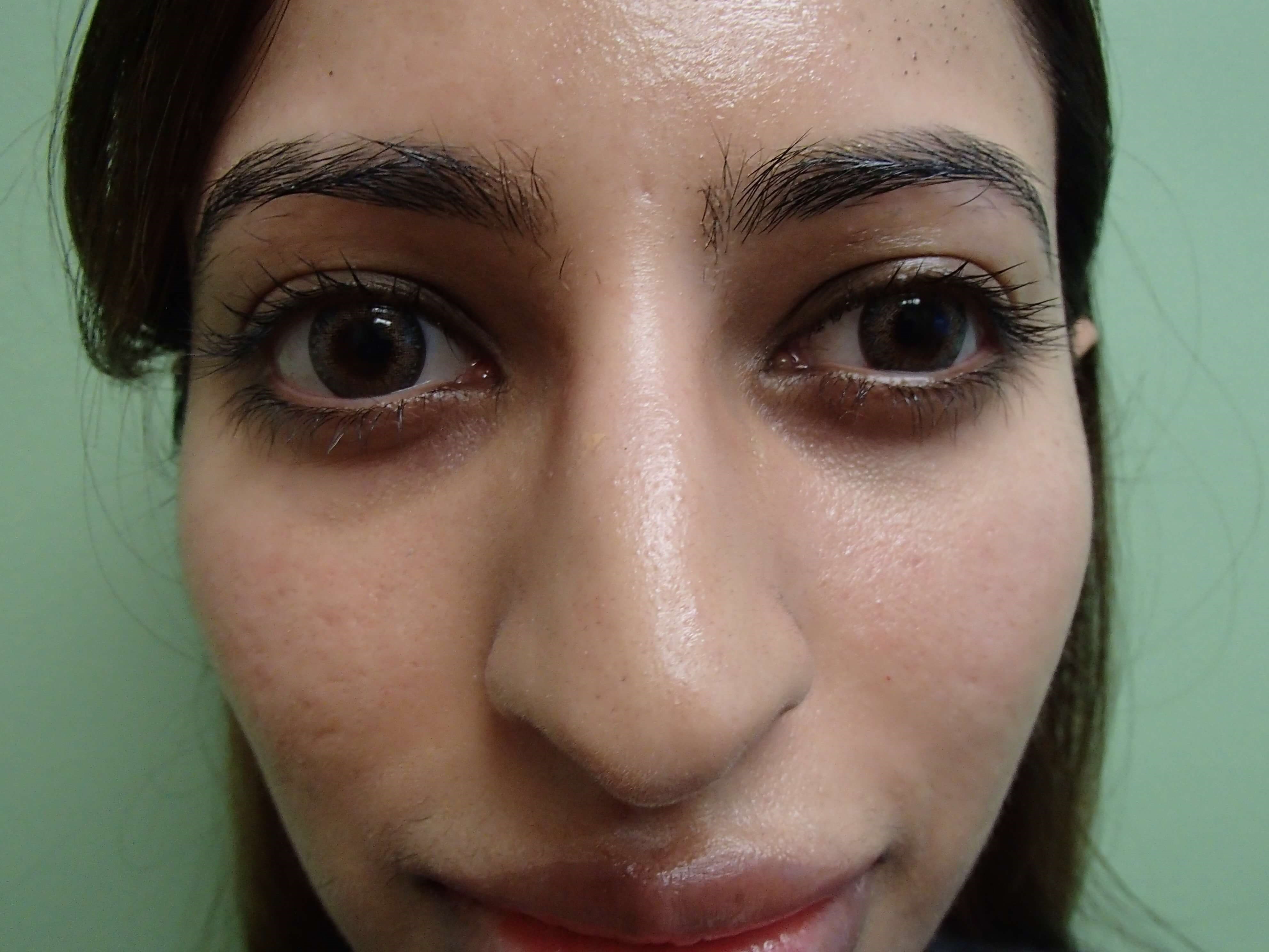 Rhinoplasty Before