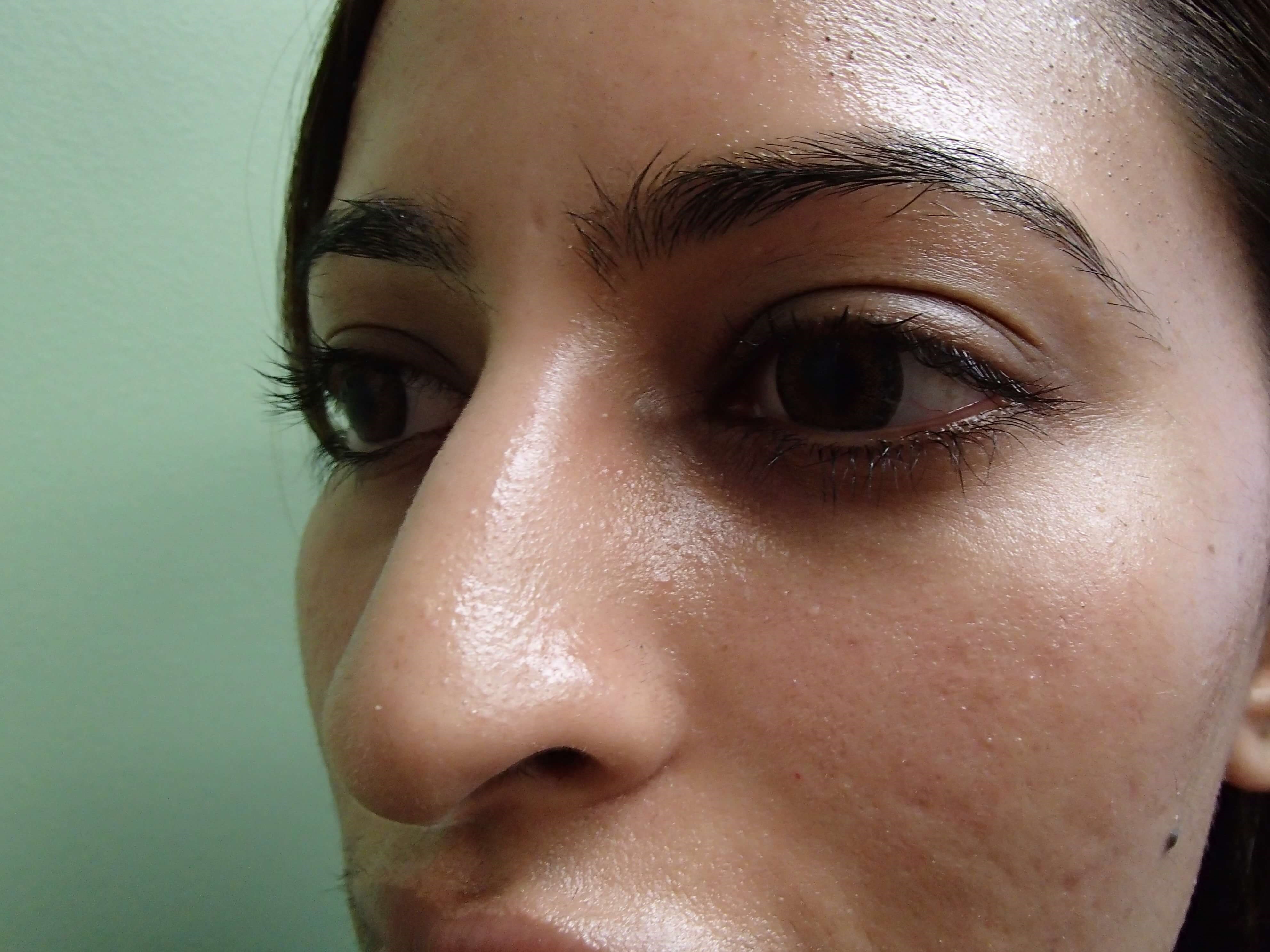 Rhinoplasty Before