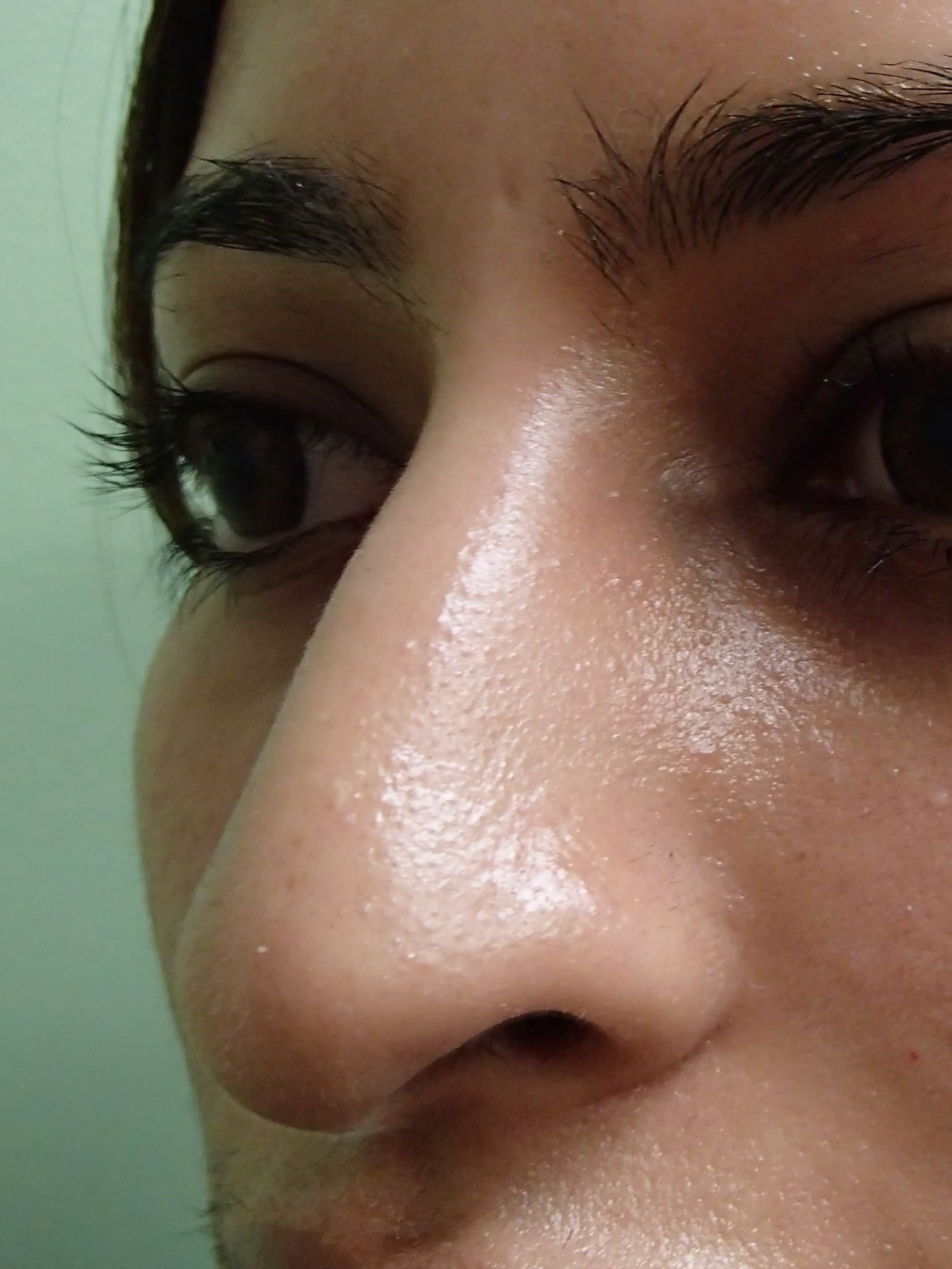 Rhinoplasty Before
