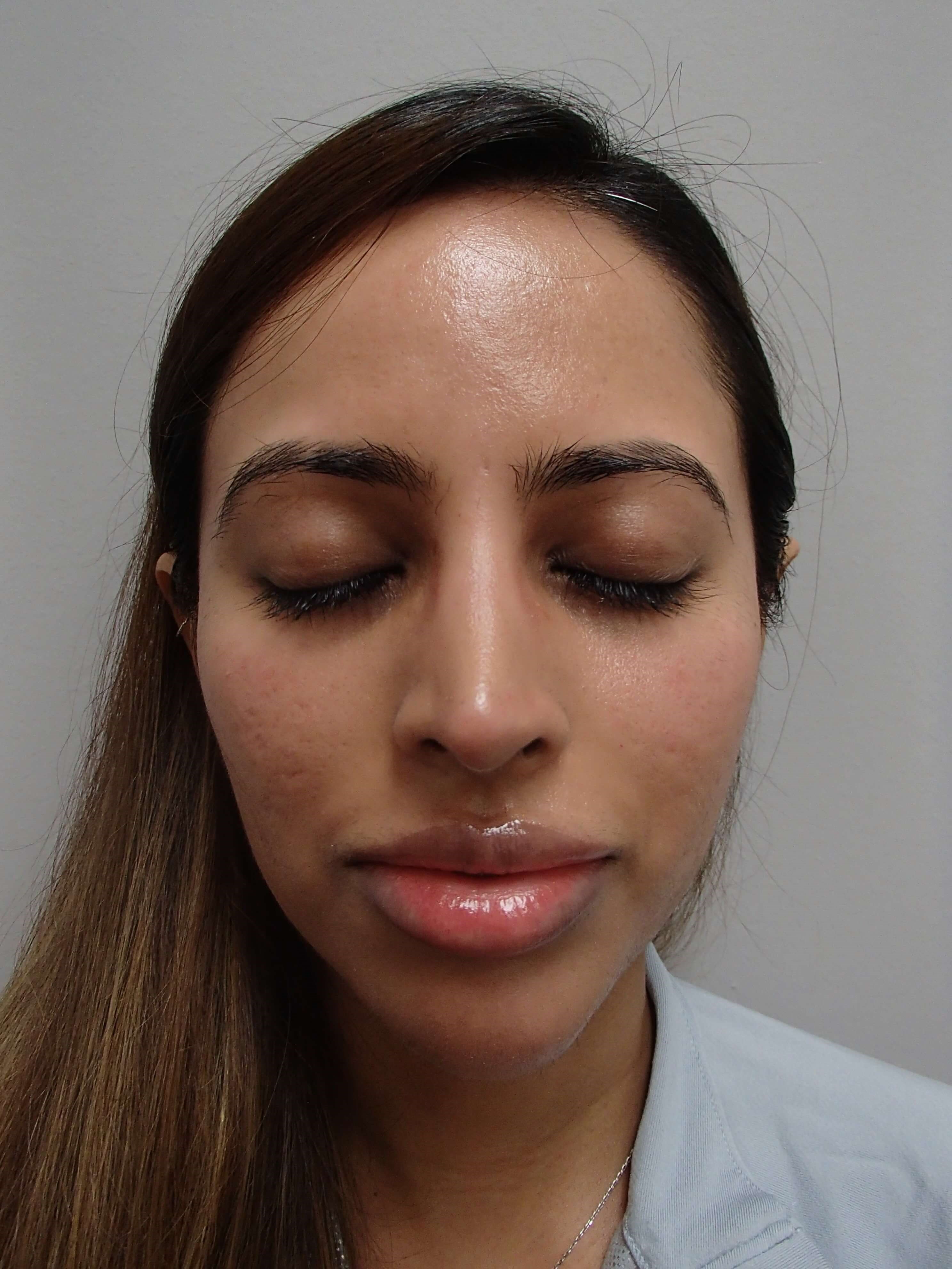 Rhinoplasty After