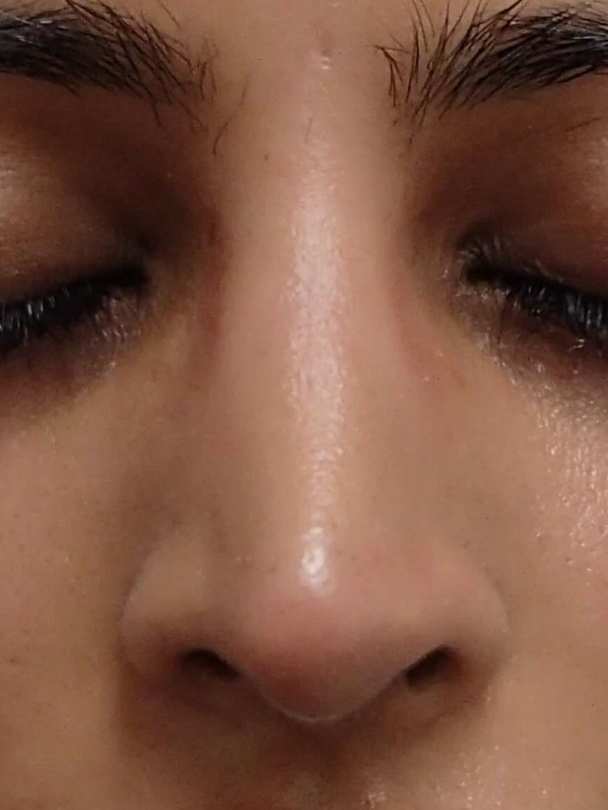 Rhinoplasty After