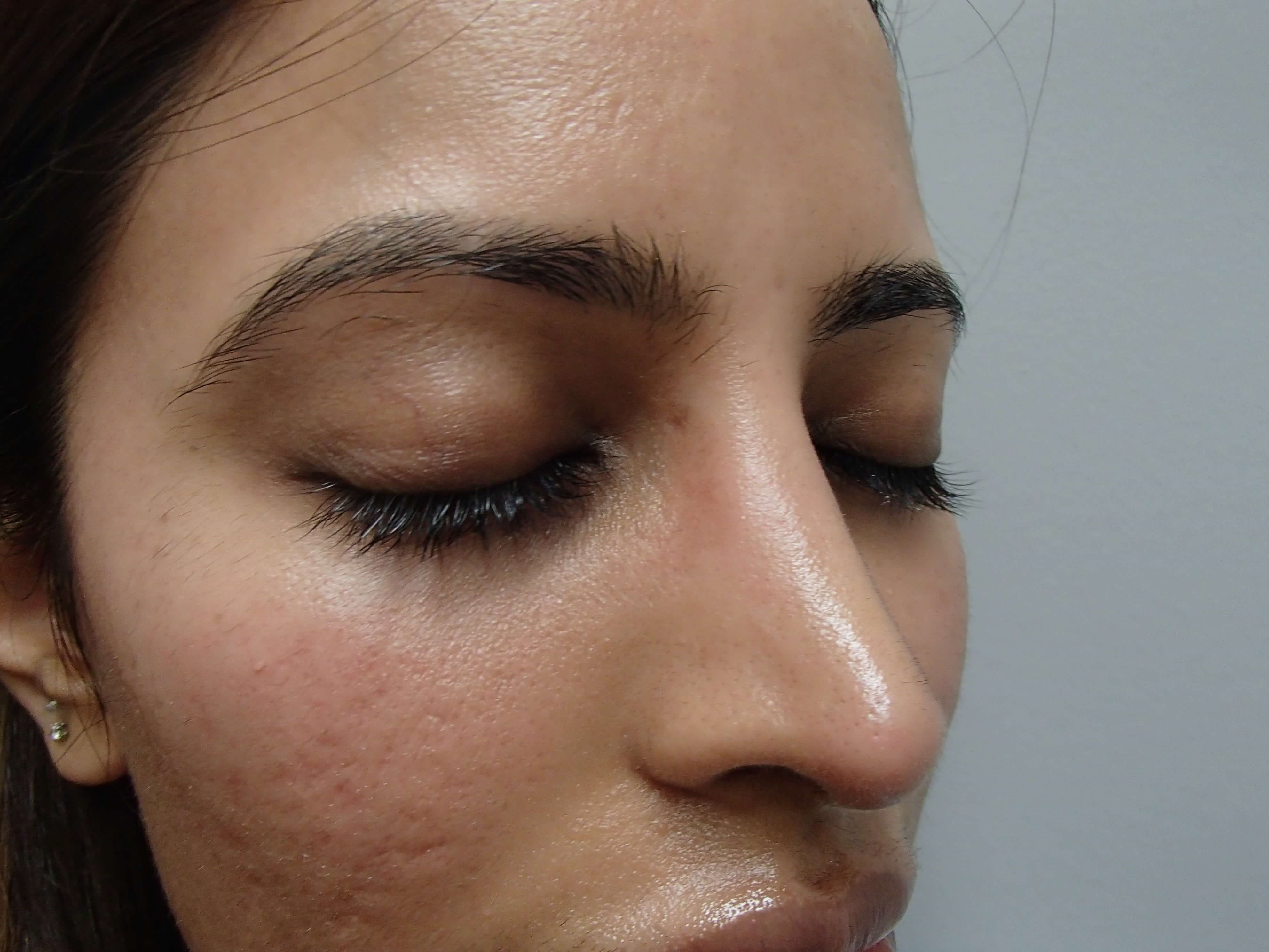 Rhinoplasty After