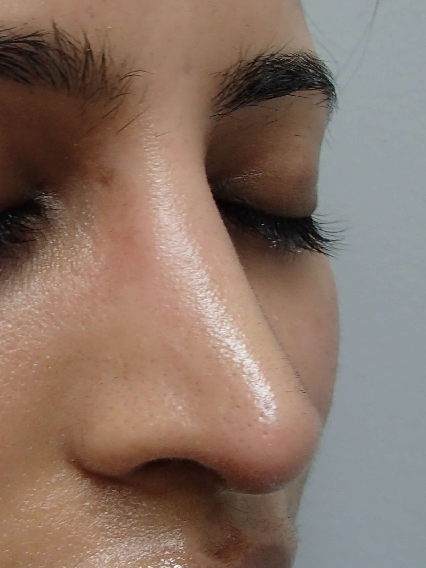 Rhinoplasty After