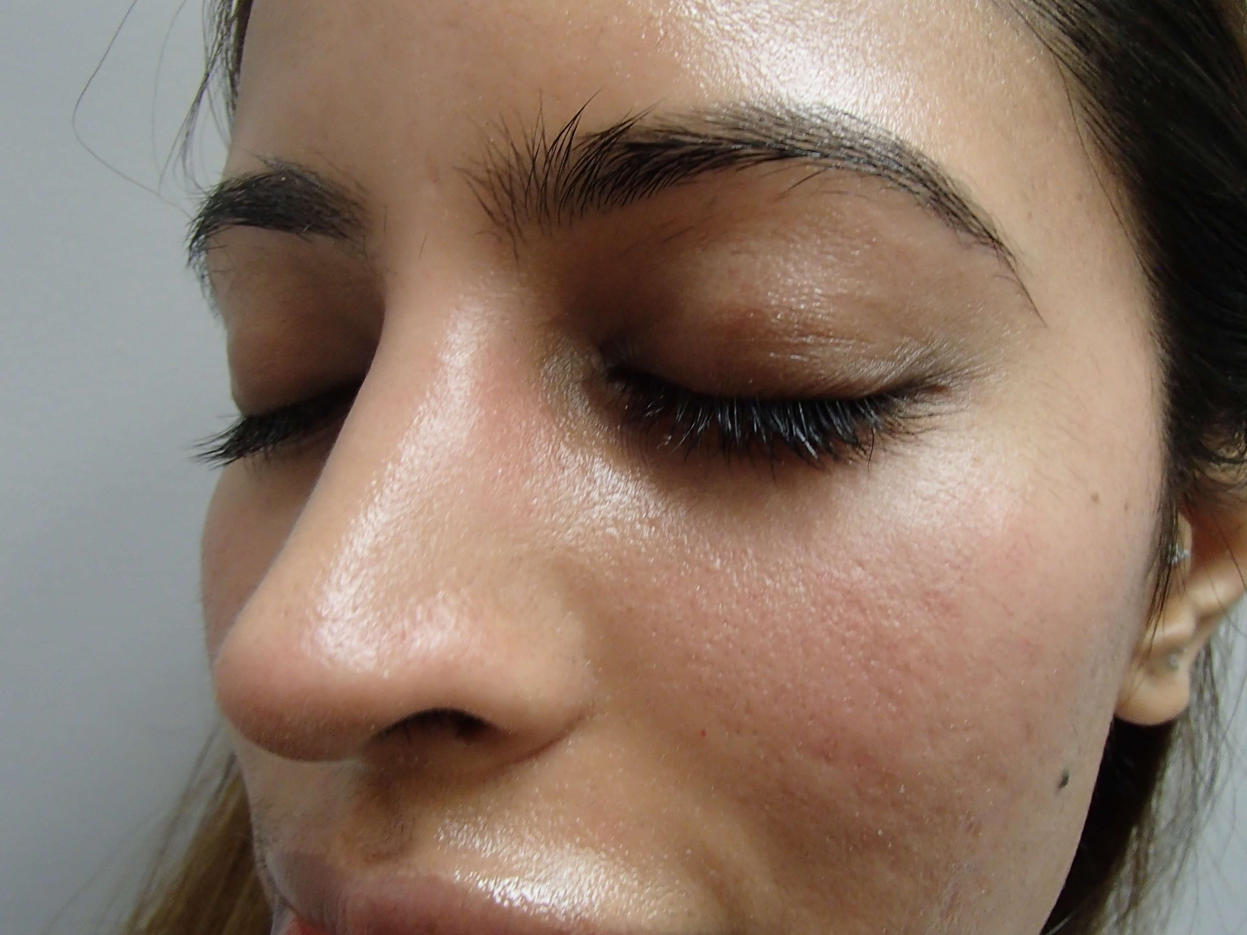 Rhinoplasty After