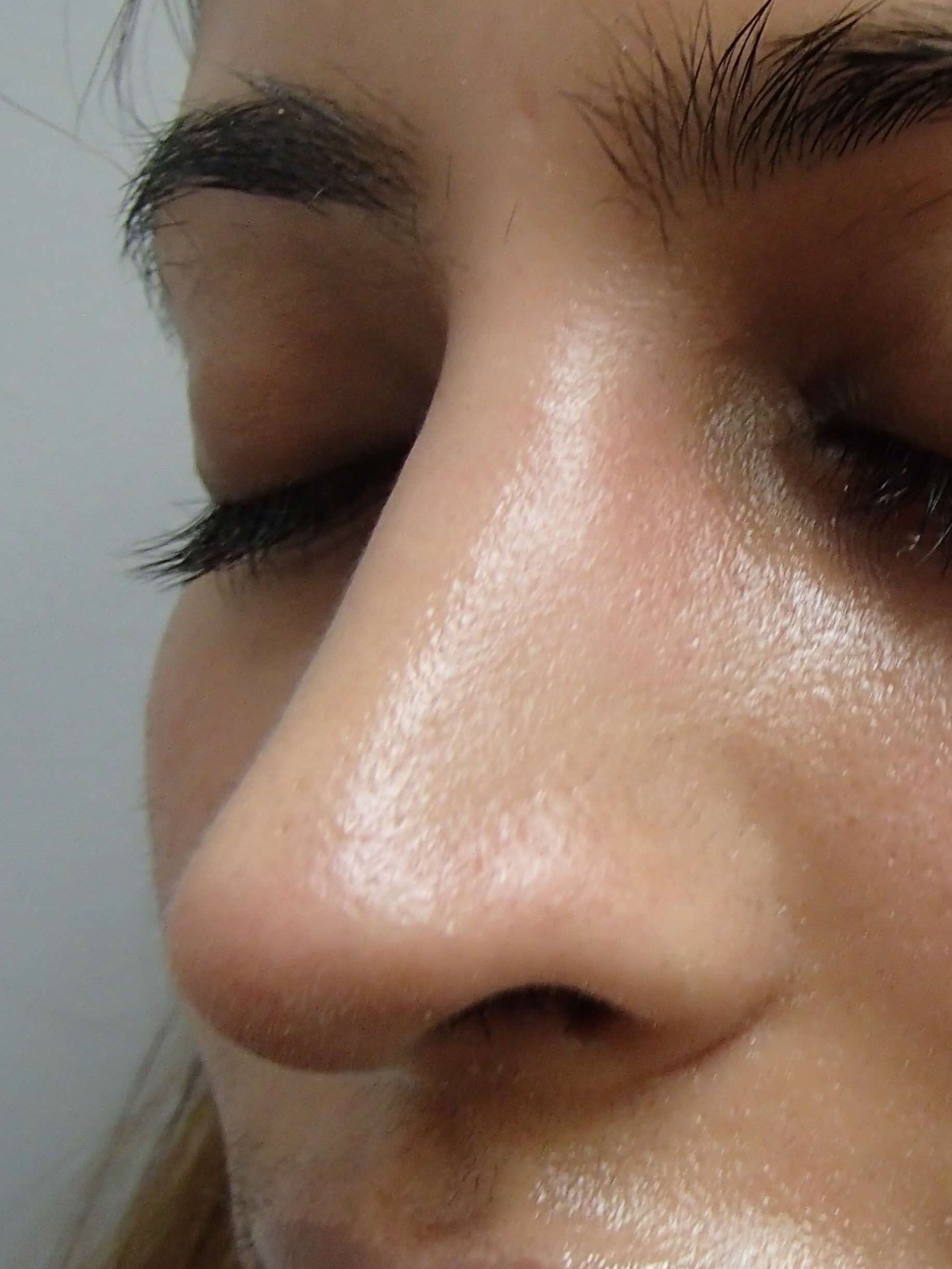 Rhinoplasty After